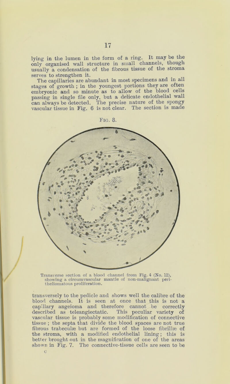 lying in the lumen in the form of a ring. It may be the only organised wall structure in small channels, though usually a condensation of the fibrous tissue of the stroma serves to strengthen it. The capillaries are abundant in most specimens and in all stages of growth ; in the youngest portions they are often embryonic and so minute as to allow of the blood cells passing in single file only, but a delicate endothelial wall can always be detected. The precise nature of the spongy vascular tissue in Fig. 6 is not clear. The section is made Fig. 8. Transverse section of a blood channel from Fig. 4 (No. 12), showing a circumvascular mantle of non-malignant peri- theliomatous proliferation. transversely to the pedicle and shows well the calibre of the blood channels. It is seen at once that this is not a capillary angeioma and therefore cannot be correctly described as teleangiectatic. This peculiar variety of vascular tissue is probably some modification of connective tissue ; the septa that divide the blood spaces are not true fibrous trabecula but are formed of the loose fibril la; of the stroma, with a modified endothelial lining; this is better brought out in the magnification of one of the areas shown in Fig. 7. The connective-tissue cells are seen to be c