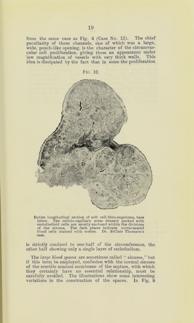 from the same case as Fig. 4 (Case No. 12). The chief peculiarity of these channels, one of which was a large, wide, pouch-like opening, is the character of the circumvas- cular cell proliferation, giving them an appearance under low magnification of vessels with very thick walls. This idea is dissipated by the fact that in some the proliferation Fig. 10. Entire longitudinal section of soft cell fibro-angeioma, base below. The cellulo-capillary areas densely packed with endothelioid cells are mostly enclosed within the divisions of the stroma. The dark places indicate extravasated blood cells stained with eosine. Dr. StClair Thomson’s case. is strictly confined to one-half of the circumference, the other half showing only a single layer of endothelium. The large blood spaces are sometimes called “ sinuses,” but if this term be employed, confusion with the normal sinuses of the erectile mucous membrane of the septum, with which they certainly have no essential relationship, must be carefully avoided. The illustrations show some interesting variations in the construction of the spaces. In Fig. 9