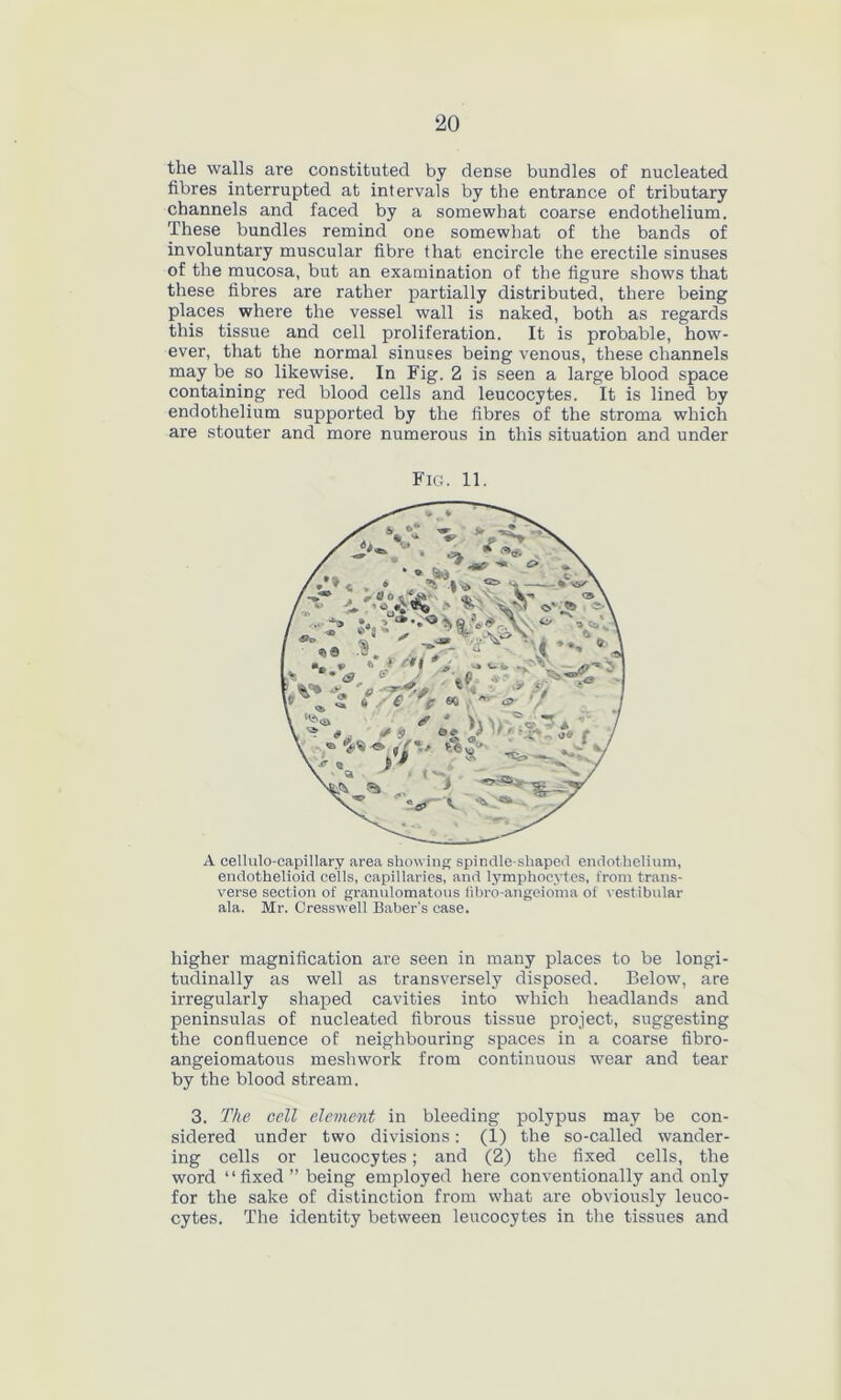 the walls are constituted by dense bundles of nucleated fibres interrupted at intervals by the entrance of tributary channels and faced by a somewhat coarse endothelium. These bundles remind one somewhat of the bands of involuntary muscular fibre that encircle the erectile sinuses of the mucosa, but an examination of the figure shows that these fibres are rather partially distributed, there being places where the vessel wall is naked, both as regards this tissue and cell proliferation. It is probable, how- ever, that the normal sinuses being venous, these channels may be so likewise. In Fig. 2 is seen a large blood space containing red blood cells and leucocytes. It is lined by endothelium supported by the fibres of the stroma which are stouter and more numerous in this situation and under Fig;. 11. A cellulo-capillary area showing spindle-shaped endothelium, endothelioid cells, capillaries, and lymphocytes, from trans- verse section of granulomatous fibro-angeioma of vestibular ala. Mr. Cresswell Baber’s case. higher magnification are seen in many places to be longi- tudinally as well as transversely disposed. Below, are irregularly shaped cavities into which headlands and peninsulas of nucleated fibrous tissue project, suggesting the confluence of neighbouring spaces in a coarse fibro- angeiomatous meshwork from continuous wear and tear by the blood stream. 3. The cell element in bleeding polypus may be con- sidered under two divisions: (1) the so-called wander- ing cells or leucocytes; and (2) the fixed cells, the word “fixed ” being employed here conventionally and only for the sake of distinction from what are obviously leuco- cytes. The identity between leucocytes in the tissues and