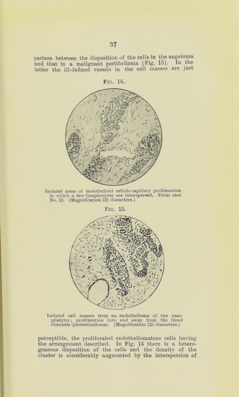 parison between the disposition of the cells in the angeioma and that in a malignant perithelioma (Fig. 15). In the latter the ill-defined vessels in the cell masses are just Fig. 14. Isolated areas of endothelioid cellulo-capillary proliferation in which a few lymphocytes are interspersed. From case No. 10. (Magnification 125 diameters.) Fig. 15. Isolated cell masses from an endothelioma of the naso- pharynx ; proliferation into and away from the blood channels (perienthelioma). (Magnification 125 diameters.) perceptible, the proliferated endotheliomatous cells having the arrangement described. In Fig. 14 there is a hetero- geneous disposition of the cells and the density of the cluster is considerably augmented by the interspersion of