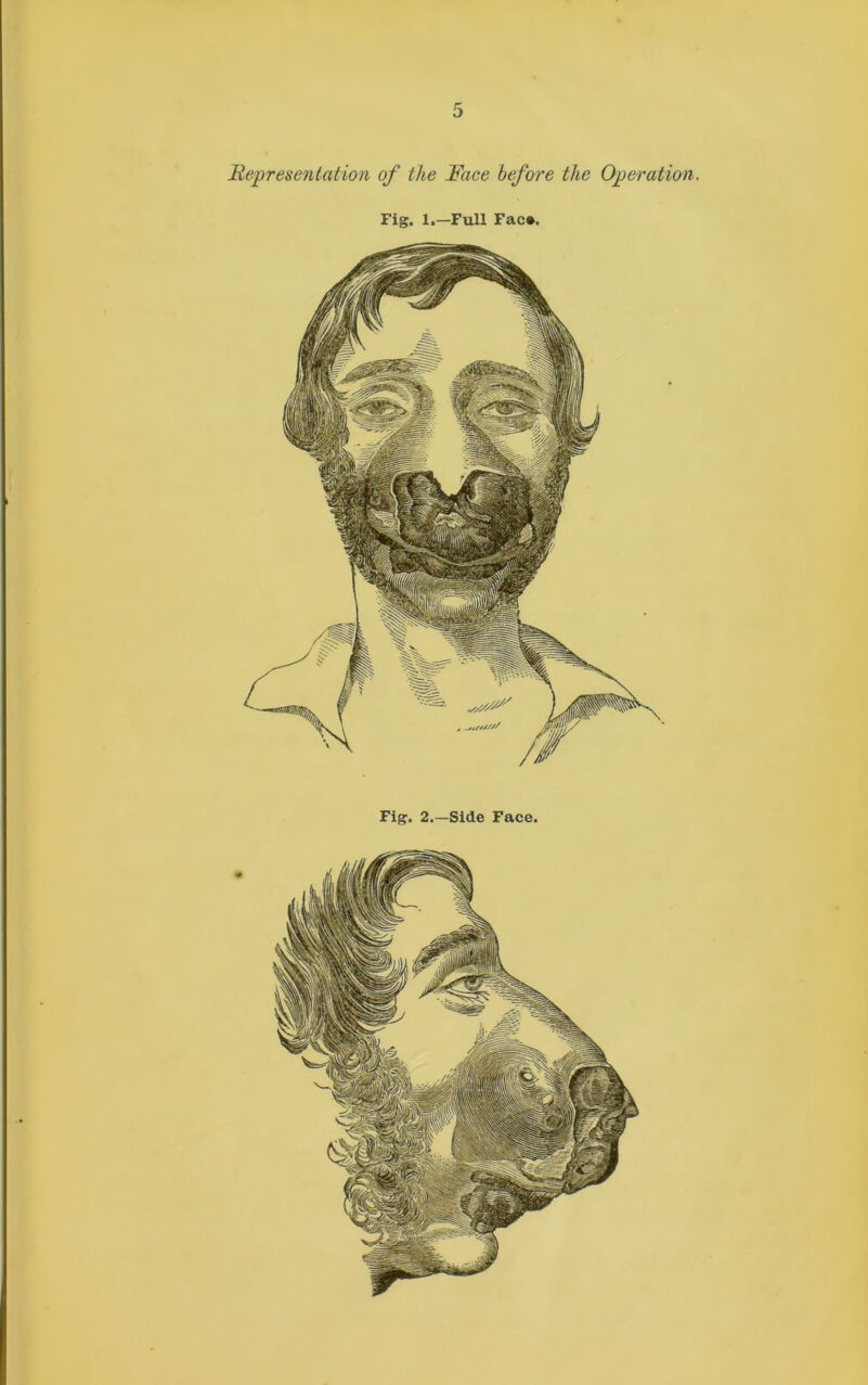 Representation of the Race before the Operation.