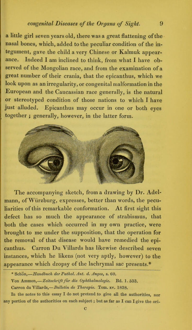a little girl seven years old, there was a great flattening of the nasal bones, which, added to the peculiar condition of the in- tegument, gave the child a very Chinese or Kalmuk appear- ance. Indeed I am inclined to think, from what I have ob- served of the Mongolian race, and from the examination of a great number of their crania, that the epicanthus, which we look upon as an irregularity, or congenital malformation in the European and the Caucassian race generally, is the natural or stereotyped condition of those nations to which I have just alluded. Epicanthus may occur in one or both eyes together ; generally, however, in the latter form. The accompanying sketch, from a drawing by Dr. Adel- mann, of Wurzburg, expresses, better than words, the pecu- liarities of this remarkable conformation. At first sight this defect has so much the appearance of strabismus, that both the cases which occurred in my own practice, were brought to me under the supposition, that the operation for the removal of that disease would have remedied the epi- canthus. Carron Du Villards has likewise described seven instances, which he likens (not very aptly, however) to the i appearance which dropsy of the lachrymal sac presents.* * Schon,—Handbuch der Pathol. Ant. d. Auges, s. 60. Yon Ammon,— Zeitschrift fur die Ophthalmologic. Bd. 1.633. Carron du Villards,—Bulletin de Therapie. Tom. xv. 1838. In the notes to this essay I do not pretend to give all the authorities, nor any portion of the authorities on each subject; but as far as I can I give the ori- C