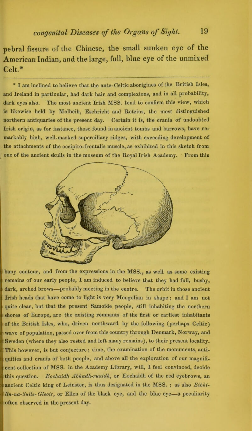 pebral fissure of the Chinese, the small sunken eye of the American Indian, and the large, full, blue eye of the unmixed Celt.* * I am inclined to believe that the ante-Celtic aborigines of the British Isles, and Ireland in particular, had dark hair and complexions, and in all probability, dark eyes also. The most ancient Irish MSS. tend to confirm this view, which is likewise held by Molbeih, Eschricht and Retzius, the most distinguished northern antiquaries of the present day. Certain it is, the crania of undoubted Irish origin, as for instance, those found in ancient tombs and barrows, have re- markably high, well-marked superciliary ridges, with exceeding development of the attachments of the occipito-frontalis muscle, as exhibited in this sketch from one of the ancient skulls in the museum of the Royal Irish Academy. From this bony contour, and from the expressions in the MSS., as well as some existing remains of our early people, I am induced to believe that they had full, bushy, dark, arched brows—probably meeting in the centre. The orbit in those ancient Irish heads that have come to light is very Mongolian in shape ; and I am not quite clear, but that the present Samoide people, still inhabiting the northern shores of Europe, are the existing remnants of the first or earliest inhabitants of the British Isles, who, driven northward by the following (perhaps Celtic) wave of population, passed over from this country through Denmark, Norway, and Sweden (where they also rested and left many remains), to their present locality. This however, is but conjecture; time, the examination of the monuments, anti- quities and crania of both people, and above all the exploration of our magnifi- cent collection of MSS. in the Academy Library, will, I feel convinced, decide this question. Eochaidh Abhadh-ruaidh, or Eochaidh of the red eyebrows, an ancient Celtic king of Leinster, is thus designated in the MSS. ; as also Eibhi- lin-na-Suite- Gleoir, or Ellen of the black eye, and the blue eye—a peculiarity often observed in the present day.