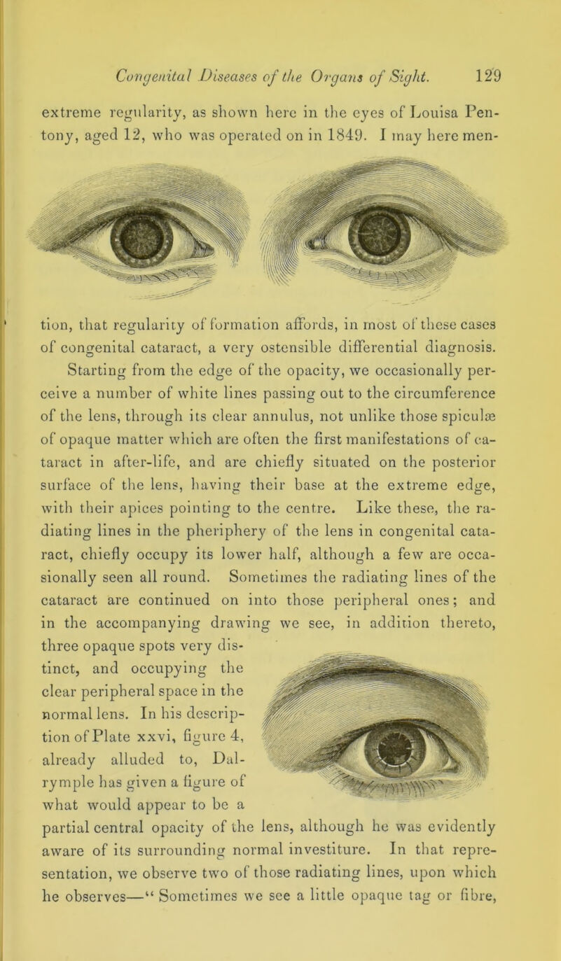 extreme regularity, as shown here in the eyes of Louisa Pen- tony, aged 12, who was operated on in 1849. I may here men- tion, that regularity of formation affords, in most of these cases of congenital cataract, a very ostensible differential diagnosis. Starting from the edge of the opacity, we occasionally per- ceive a number of white lines passing out to the circumference of the lens, through its clear annulus, not unlike those spiculte of opaque matter which are often the first manifestations of ca- taract in after-life, and are chiefly situated on the posterior surface of the lens, having their base at the extreme edge, with their apices pointing to the centre. Like these, the ra- diating lines in the pheriphery of the lens in congenital cata- ract, chiefly occupy its lower half, although a few are occa- sionally seen all round. Sometimes the radiating lines of the cataract are continued on into those peripheral ones; and in the accompanying drawing we see, in addition thereto, three opaque spots very dis- tinct, and occupying the clear peripheral space in the normal lens. In his descrip- tion of Plate xxvi, figure 4, already alluded to, Dal- rymple has given a figure of what Avould appear to he a partial central opacity of the lens, although he was evidently aware of its surrounding normal investiture. In that repre- sentation, we observe two of those radiating lines, upon which he observes—“ Sometimes we see a little opaque tag or fibre,