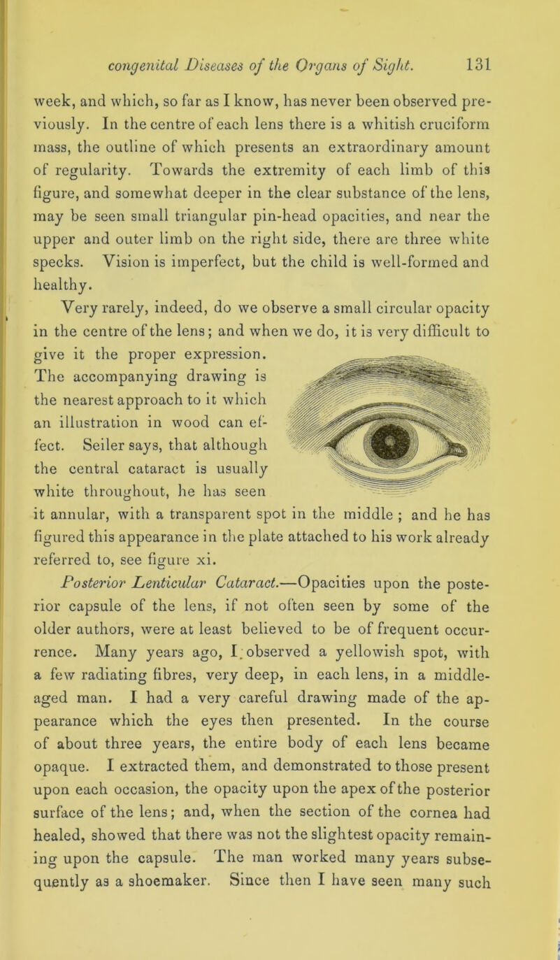 week, and which, so far as I know, has never been observed pre- viously. In the centre of each lens there is a whitish cruciform mass, the outline of which presents an extraordinary amount of regularity. Towards the extremity of each limb of this figure, and somewhat deeper in the clear substance of the lens, may be seen small triangular pin-head opacities, and near the upper and outer limb on the right side, there are three white specks. Vision is imperfect, but the child is well-formed and healthy. Very rarely, indeed, do we observe a small circular opacity in the centre of the lens; and when we do, it is very difficult to give it the proper expression. The accompanying drawing is the nearest approach to it which an illustration in wood can ef- fect. Seiler says, that although the central cataract is usually white throughout, he has seen it annular, with a transparent spot in the middle ; and he has figured this appearance in the plate attached to his work already referred to, see figure xi. Posterior Lenticular Cataract.—Opacities upon the poste- rior capsule of the lens, if not often seen by some of the older authors, were at least believed to be of frequent occur- rence. Many years ago, I. observed a yellowish spot, with a few radiating fibres, very deep, in each lens, in a middle- aged man. I had a very careful drawing made of the ap- pearance which the eyes then presented. In the course of about three years, the entire body of each lens became opaque. I extracted them, and demonstrated to those present upon each occasion, the opacity upon the apex of the posterior surface of the lens; and, when the section of the cornea had healed, showed that there was not the slightest opacity remain- ing upon the capsule. The man worked many years subse- quently as a shoemaker. Since then I have seen many such