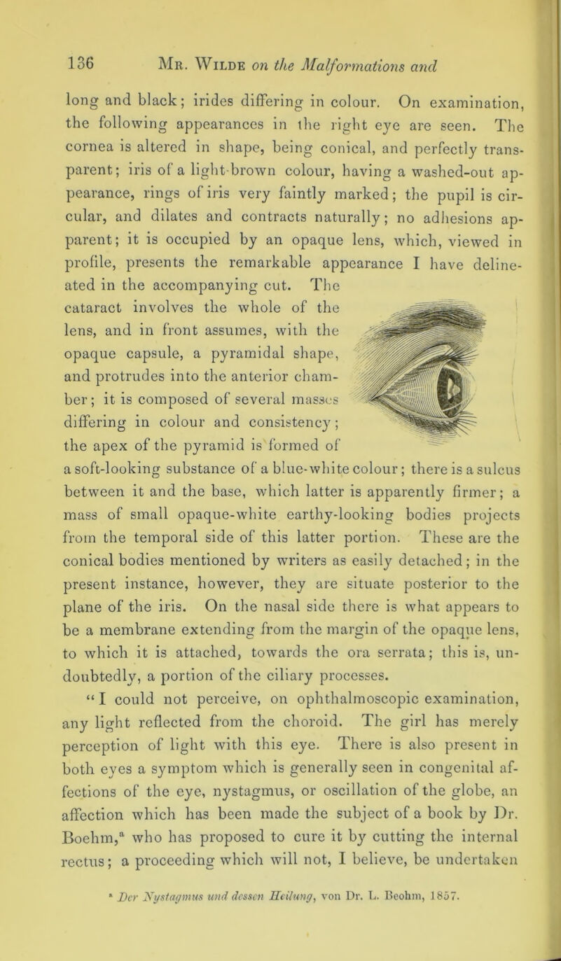 long and black; irides differing in colour. On examination, the following appearances in the right eye are seen. The cornea is altered in shape, being conical, and perfectly trans- parent; iris of a light-brown colour, having a washed-out ap- pearance, rings of iris very faintly marked; the pupil is cir- cular, and dilates and contracts naturally; no adhesions ap- parent; it is occupied by an opaque lens, which, viewed in profile, presents the remarkable appearance I have deline- ated in the accompanying cut. The cataract involves the whole of the lens, and in front assumes, with the opaque capsule, a pyramidal shape, and protrudes into the anterior cham- ber; it is composed of several masses differing in colour and consistency; the apex of the pyramid is formed of a soft-looking substance of a blue-white colour; there is a sulcus between it and the base, which latter is apparently firmer; a mass of small opaque-white earthy-looking bodies projects from the temporal side of this latter portion. These are the conical bodies mentioned by writers as easily detached; in the present instance, however, they are situate posterior to the plane of the iris. On the nasal side there is what appears to be a membrane extending from the margin of the opaque lens, to which it is attached, towards the ora serrata; this is, un- doubtedly, a portion of the ciliary processes. “ I could not perceive, on ophthalmoscopic examination, any light reflected from the choroid. The girl has merely perception of light with this eye. There is also present in both eyes a symptom which is generally seen in congenital af- fections of the eye, nystagmus, or oscillation of the globe, an affection which has been made the subject of a book by Dr. Boehm,a who has proposed to cure it by cutting the internal rectus; a proceeding which will not, I believe, be undertaken * Her Nystagmus und dessen He Hung, von Dr. L. Beohm, 1857.