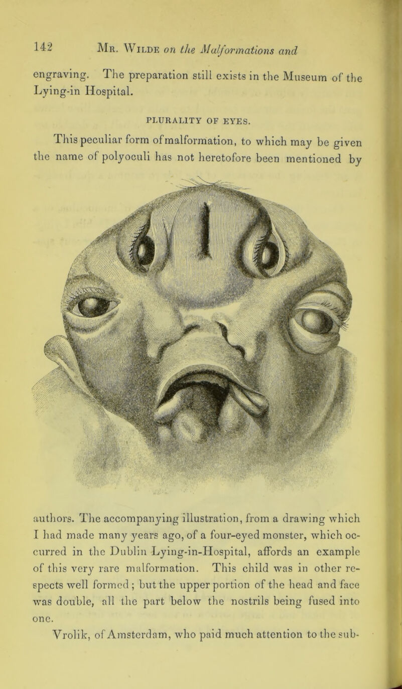 engraving. The preparation still exists in the Museum of the Lying-in Hospital. PLURALITY OF EYES. This peculiar form of malformation, to which may be given the name of polyoculi has not heretofore been mentioned by authors. The accompanying illustration, from a drawing which I had made many years ago, of a four-eyed monster, which oc- curred in the Dublin Lying-in-Hospital, affords an example of this very rare malformation. This child was in other re- spects well formed ; but the upper portion of the head and face was double, all the part below the nostrils being fused into one. Vrolik, of Amsterdam, who paid much attention to the sub-