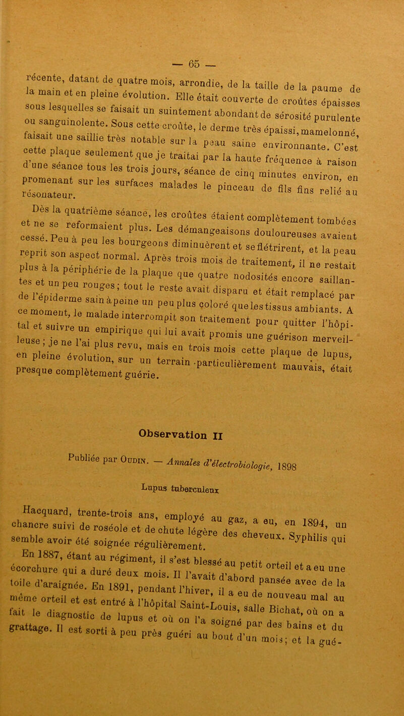 récente, datant de quatre mois, arrondie, de la taille de la paume de a ma,n et en pleine évolution. Elle était couverte de or^éZ^ nous lesquelles se faisait un suintement abondant de sérosité purulente ou sanguinolente. Sous cette croûte, le derme très épaissi, mamelonné aisa,t une sanl.e très notable sur la peau saine environnante. C'est’ cette plaque seulement .que je traitai par la haute fréquence à raison c une seance tous les trois jours, séance de cinq minutes environ en ““ rleS SUrfaCeS “ b ^s relié au et neS‘: ^ ‘•«Mo. cessé Peu à „ démangeaisons douloureuses avaient sse. Peu a peu les bourgeons diminuèrent et seflétrirent et h , rep;,t son aspect normal. Après trois mois de traitel^ il ne HZ tes et a PeP 6116 de ia P'aque que quatre n°d°sités encore saillan es et peu rou?es ; tout |e reste avau d.spara ^ re a 11 “ ce mo^n: Sm“ape7 “ ■*» «*>* que les tissus ambiant/A x , , . ' d'e interrompu son traitement pour quitter l’hôni le / Tn/r TPiriqUe ,Ui *'*« —« nE5 Observation II Publiée par Oudin. - Annales d'électrobiologie, 1898 Lupus tuberculeux Haequard, trente-trois ans, employé an o„, _ chancre suivi de roséole et de chute légère des ch! 6U’ 4’ “ semble avoir été soignée régulièrement re,U‘ 7P  qU‘ En 1887, étant au régiment, il s’est blessé au petit orteil „ - ixzz zzt::: grattage. 1, est sorti h peu près guéri au guÜ