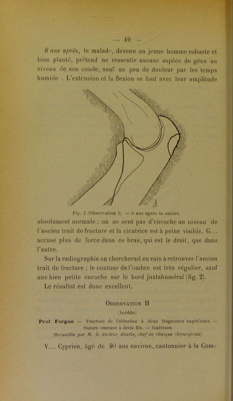 — iO 0 (lus après, le malad--, devenu un jeune homme robuste el bien planté, prétend ne ressentir aucune espèce de gène au niveau de son coude, sauf un peu de douleur par les temps humide . L’extension et la flexion se font avec leur amplitude Fiij. 2 (Obsprvalion IJ. — 6 ans après la suliire. absolument normale; on ne sent pas d’encoche au niveau de raiicien trait de fracture et la cicatrice est à peine visible. G... accuse plus de force dans ce bras, qui est le droit, que dans l’autre. Sur la radiographie op chercherait en vain à retrouver l’ancien trait de fracture ; le contour de l’ombre est très régulier, sauf une bien petite encoche sur le bord juxtahuméral (fig. 2). I.e résultat est donc excellent. Observation II (Inédite) Prof. Forgue. — Fracture de l’olécrâne à deux fragments supérieurs. — Suture osseuse à deux fils. — Guérison [Recueillie par M. le docteur Abadie, chef de clinique chirurgicale) \... Cyprien, âgé de -W ans environ, cantonnier à la Corn-