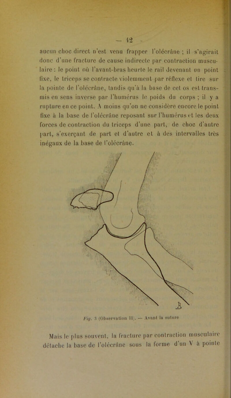 — i^2 - aucun choc direct n’est venu frapper l’olécràne ; il s’agirait donc d’une fracture de cause indirecte [>ar contraction muscu- laire : le point où l’avant-bras lieurte le rail devenant un point fixe, le triceps se contracte violemment par réllexe et tire sur la |iointe de l’olccràne, tandis qu’à la base de cet os est trans- mis en sens inverse par riiumérus b^ poids du corps ; il y a rupture en ce point. A moins qu’on ne considère encore le point fixe à la base de l’olccràne reposant sur l’bumérusct les deux forces de contraction du triceps d’une part, de choc d’autre part, s’exerçant de part et d’autre et à des intervalles très inégaux de la base de l’olécràne. Fig. 3 (Ol)servalion 11 . — Avant la suture h .4 1 1 i f I fi Mais le plus souvent, la fracttire par contraction mtisculaire détache la base de l’olccrâne sous la forme d’un V à pointe