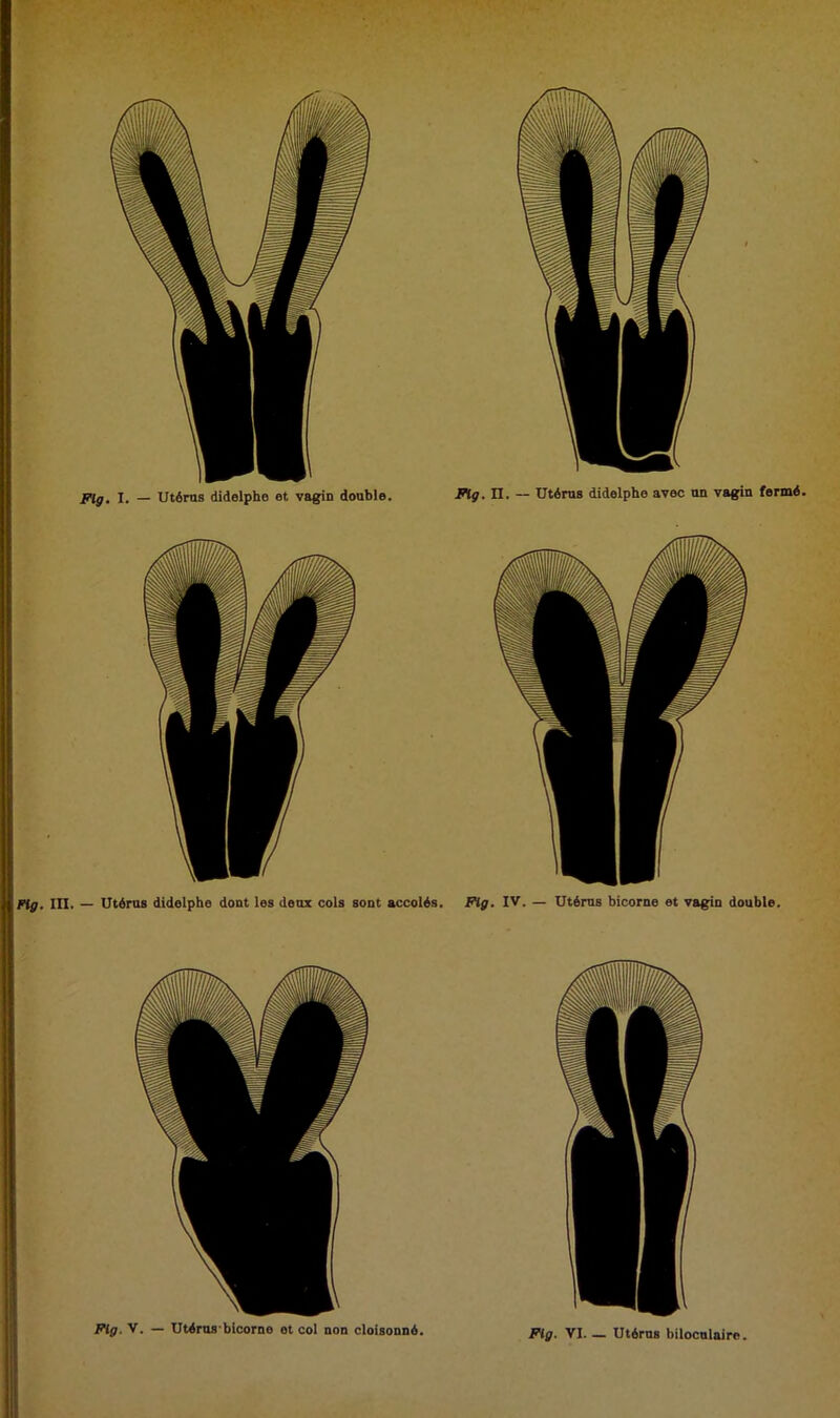 Fig. V. — Utérus1 bicorno et col non cloisonné. Fig. VI. — Utérus biloculairo.