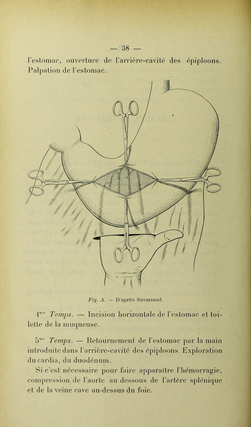 l’estomac, ouverture de l’arrière-cavité des épiploons. Palpation de l’estomac. Fig. A. — D'après Savariaud. 4m0 Temps. — Incision horizontale de l’estomac et toi- lette de la muqueuse. 5mc Temps. — Retournement de l’estomac par la main introduite dans l’arrière-cavité des épiploons. Exploration du cardia, du duodénum. Si c’est nécessaire pour faire apparaître l’hémorragie, compression de l’aorte au dessous de l’artère splénique et de la veine cave au-dessus du foie.