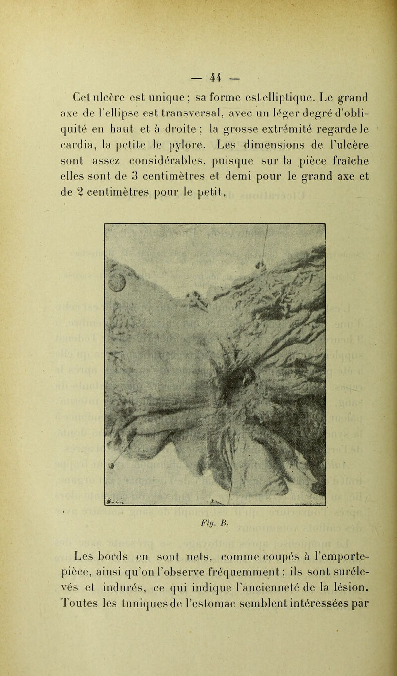 Cet ulcère est unique ; sa forme estelliptique. Le grand axe de l'ellipse est transversal, avec un léger degré d’obli- quité en haut et à droite; la grosse extrémité regarde le cardia, la petite le pylore. Les dimensions de l’ulcère sont assez considérables, puisque sur la pièce fraîche elles sont de 3 centimètres et demi pour le grand axe et de 2 centimètres pour le petit, Fig. B. Les bords en sont nets, comme coupés à l’emporte- pièce, ainsi qu’on l’observe fréquemment ; ils sont suréle- vés et indurés, ce qui indique l’ancienneté de la lésion. Toutes les tuniques de l’estomac semblent intéressées par