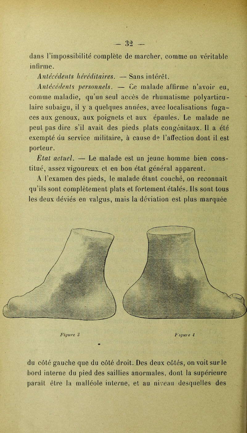 dans l’impossibilité complète de marcher, comme un véritable infirme. Antécédents héréditaires. — Sans intérêt. Antécédents personnels. — Ce malade affirme n’avoir eu, comme maladie, qu’un seul accès de rhumatisme polyarticu- laire subaigu, il y a quelques années, avec localisations fuga- ces aux genoux, aux poignets et aux épaules. Le malade ne peut pas dire s’il avait des pieds plats congénitaux. Il a été exempté du service militaire, à cause d*3 l’affection dont il est porteur. État actuel. — Le malade est un jeune homme bien cons- titué, assez vigoureux et en bon état général apparent. A l’examen des pieds, le malade étant couché, on reconnaît qu’ils sont complètement plats et fortement étalés. Ils sont tous les deux déviés en valgus, mais la déviation est plus marquée du côté gauche que du côté droit. Des deux côtés, on voit sur le bord interne du pied des saillies anormales, dont la supérieure paraît être la malléole interne, et au niveau desquelles des