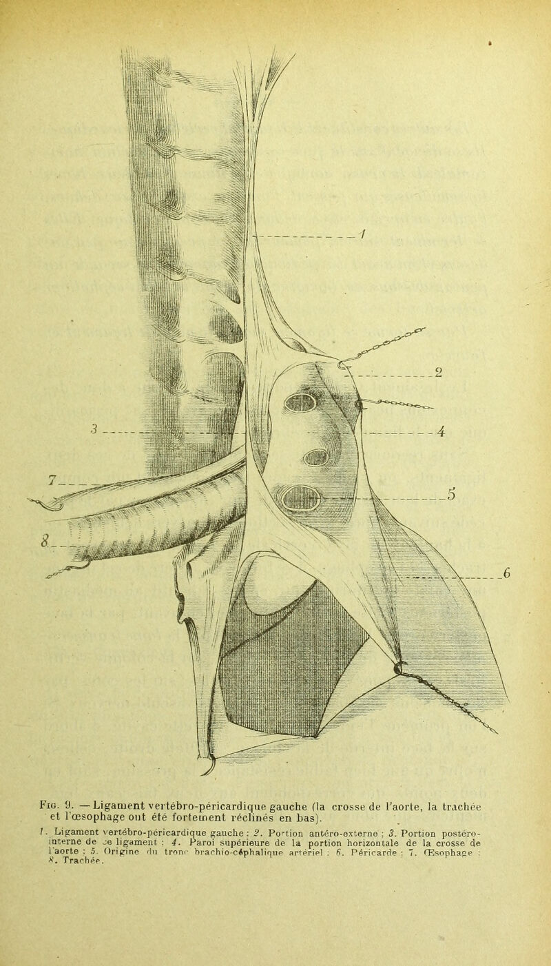Fig. 9. —Ligament vertébro-péricardique gauche (la crosse de l'aorte, la trachée et l’œsophage ont été fortement réclinés en bas). 1. Ligament vertébro-péricardique gauche : 2. Portion antéro-externe ; 3. Portion postéro- mterne de je ligament. : 4. Paroi supérieure de la portion horizontale de la crosse de 1 aorte : 5. Origine du tronc brarhio-céphalique artériel ; fi. Péricarde : 7. Œsophape : Trachée.