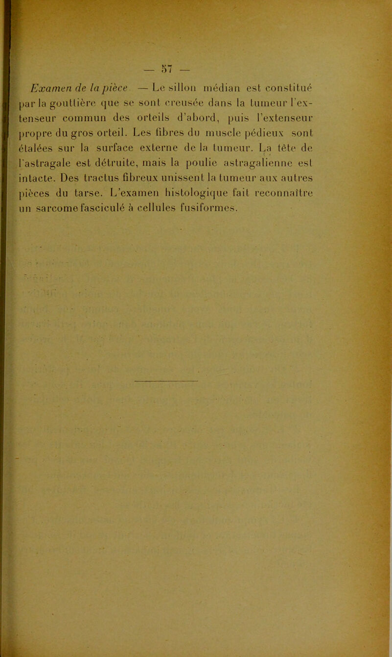 Examen de la pièce — Le sillon médian est constitué |)ar la gouttière que se sont creusée dans la tuineur l’ex- tenseur commun des orteils d’abord, puis l’extenseur propre du gros orteil. Les libres du muscle pédieux sont étalées sur la surface externe de la tumeur. I^a tète de K ■ l'astragale est détruite, mais la poulie astragalienne est intacte. Des tractus fibreux unissent la tumeur aux auti’es pièces du tarse. L’examen histologique fait reconnaître un sarcome fasciculé à cellules fusiformes.