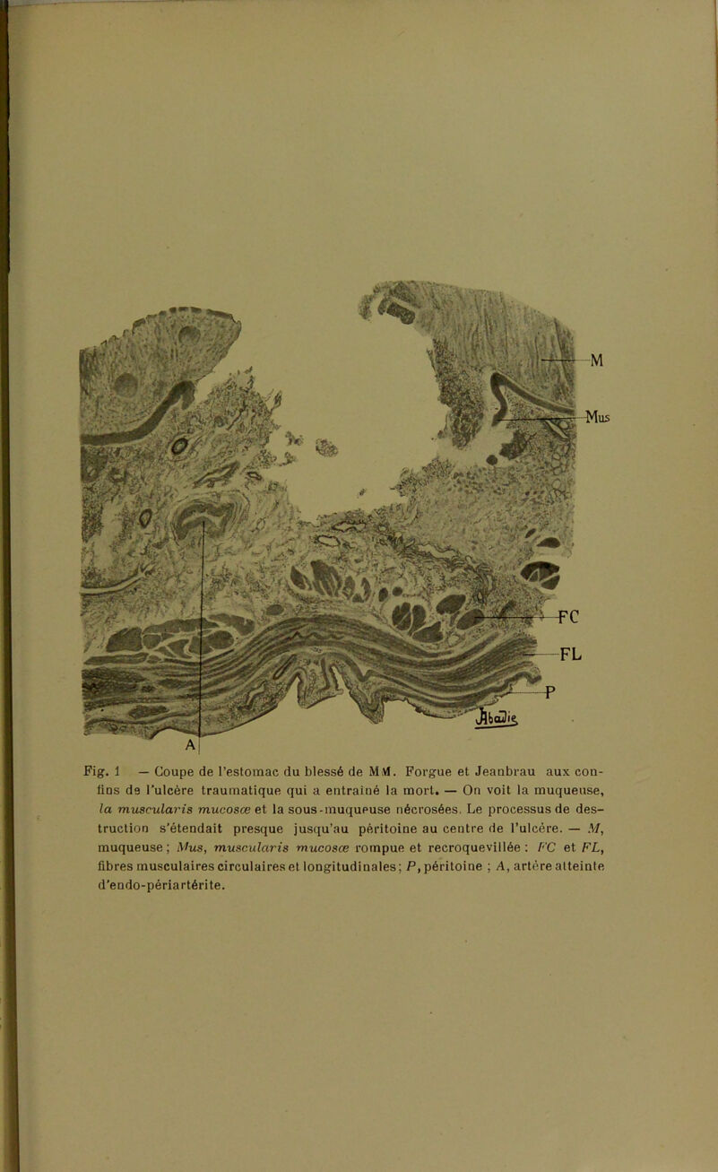 Fig. 1 — Coupe de l’estomac du blessé de MM. Forgue et Jeanbrau aux con- fins de l’ulcère traumatique qui a entraîné la mort. — On voit la muqueuse, la muscularis mucosœ et la sous-muqueuse nécrosées. Le processus de des- truction s’étendait presque jusqu’au péritoine au centre de l’ulcère. — AT, muqueuse ; Mus, muscularis mucosœ rompue et recroquevillée : FC et FL, fibres musculaires circulaires et longitudinales; P, péritoine ; A, artère atteinte d’endo-périartérite.