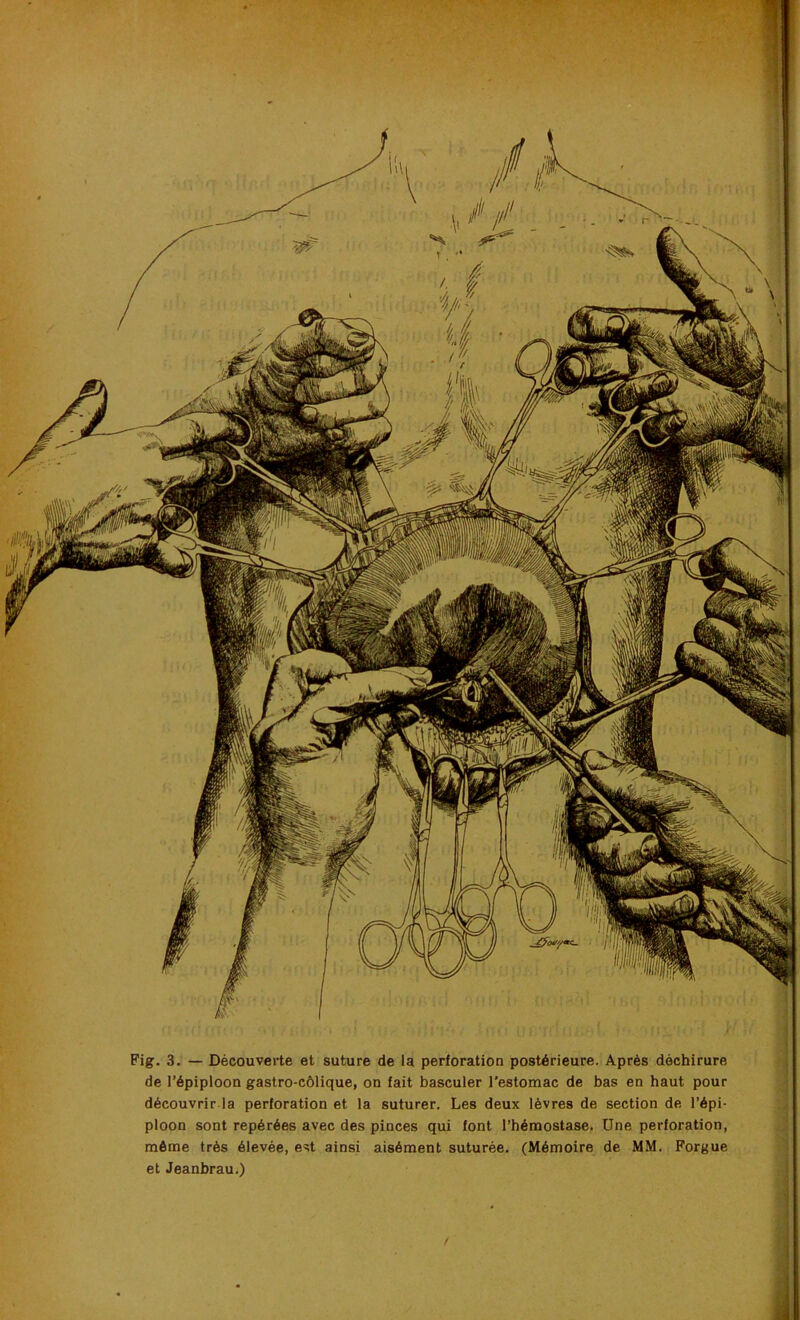 Fig. 3. — Découverte et suture de la perforation postérieure. Après déchirure de l’épiploon gastro-côlique, on fait basculer l’estomac de bas en haut pour découvrir la perforation et la suturer. Les deux lèvres de section de l’épi- ploon sont repérées avec des pinces qui font l’hémostase. Une perforation, môme très élevée, est ainsi aisément suturée. (Mémoire de MM. Forgue et Jeanbrau.)