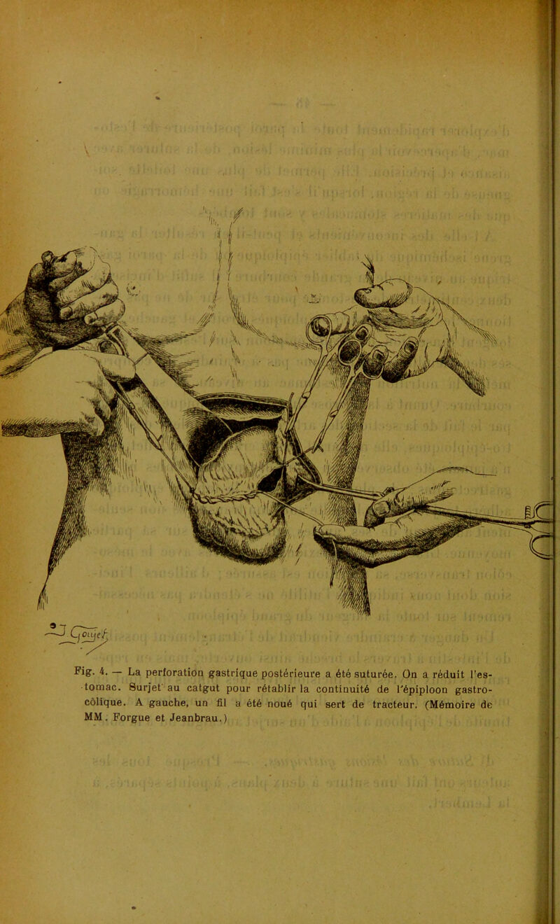 Fig. 4. — La perforation gastrique postérieure a été suturée. On a réduit l’es- tomac. Surjet' au catgut pour rétablir la continuité de l'épiploon gastro- côlique. A gauche, un fil a été noué qui sert de tracteur. (Mémoire de MM. Forgue et Jeanbrau.) 9 ~r C^cûjef