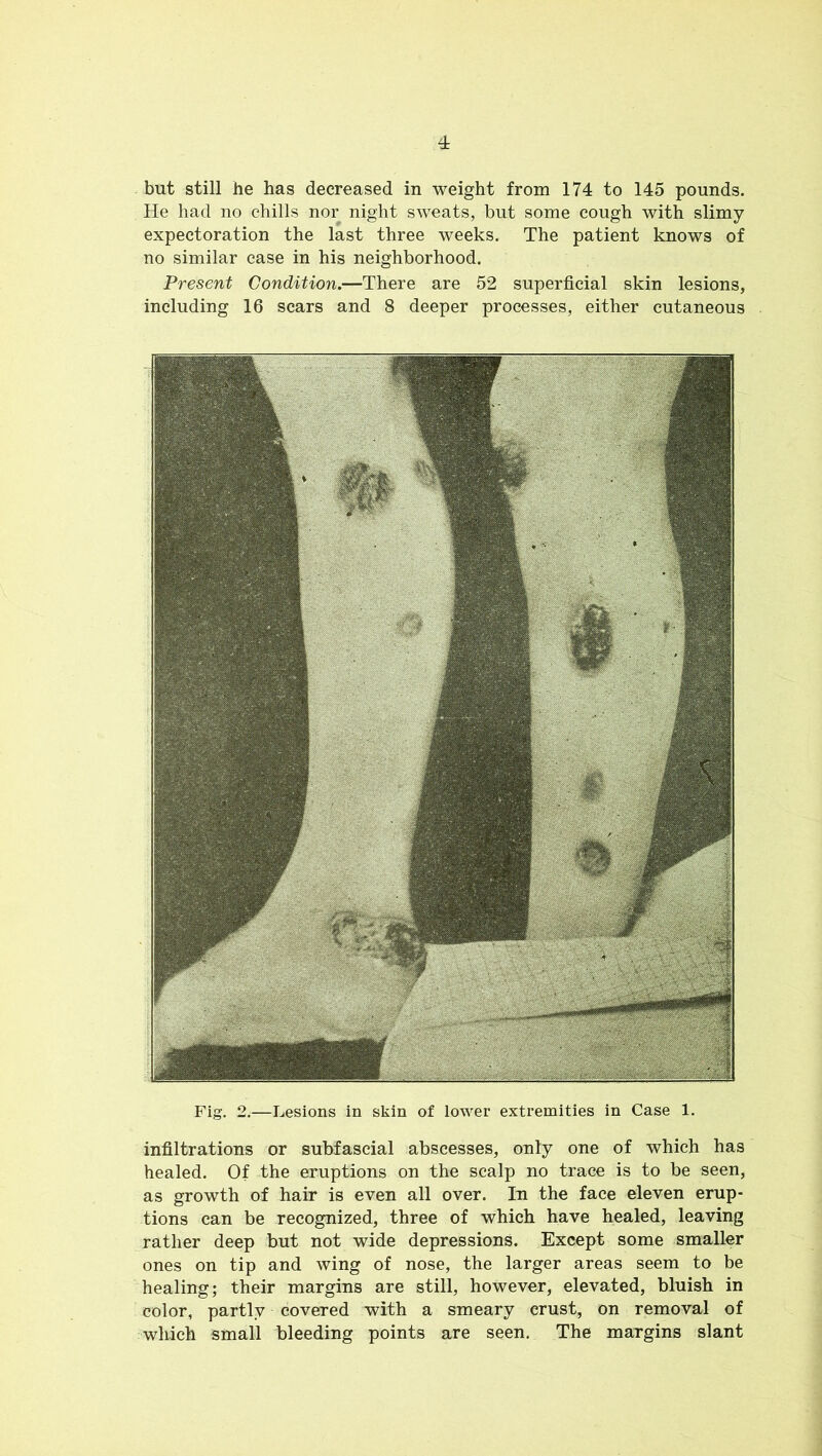 but still he has decreased in weight from 174 to 145 pounds. He had no chills nor night sweats, but some cough with slimy expectoration the last three weeks. The patient knows of no similar case in his neighborhood. Present Condition.—There are 52 superficial skin lesions, including 16 scars and 8 deeper processes, either cutaneous Fig. 2.—Lesions in skin of lower extremities in Case 1. infiltrations or subfascial abscesses, only one of which has healed. Of the eruptions on the scalp no trace is to be seen, as growth of hair is even all over. In the face eleven erup- tions can be recognized, three of which have healed, leaving rather deep but not wide depressions. Except some smaller ones on tip and wing of nose, the larger areas seem to be healing; their margins are still, however, elevated, bluish in color, partly covered with a smeary crust, on removal of which small bleeding points are seen. The margins slant