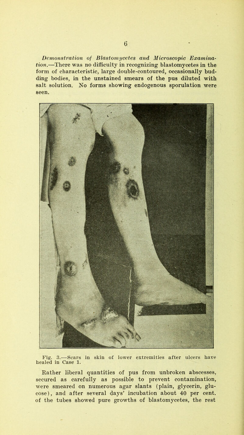Demonstration of Blastomycetes and Microscopic Examina- tion.—There was no difficulty in recognizing blastomycetes in the form of characteristic, large double-contoured, occasionally bud- ding bodies, in the unstained smears of the pus diluted with salt solution. No forms showing endogenous sporulation were seen. Fig. 3.—Scars in skin of lower extremities after ulcers have healed in Case 1. Rather liberal quantities of pus from unbroken abscesses, secured as carefully as possible to prevent contamination, were smeared on numerous agar slants (plain, glycerin, glu- cose), and after several days’ incubation about 40 per cent, of the tubes showed pure growths of blastomycetes, the rest