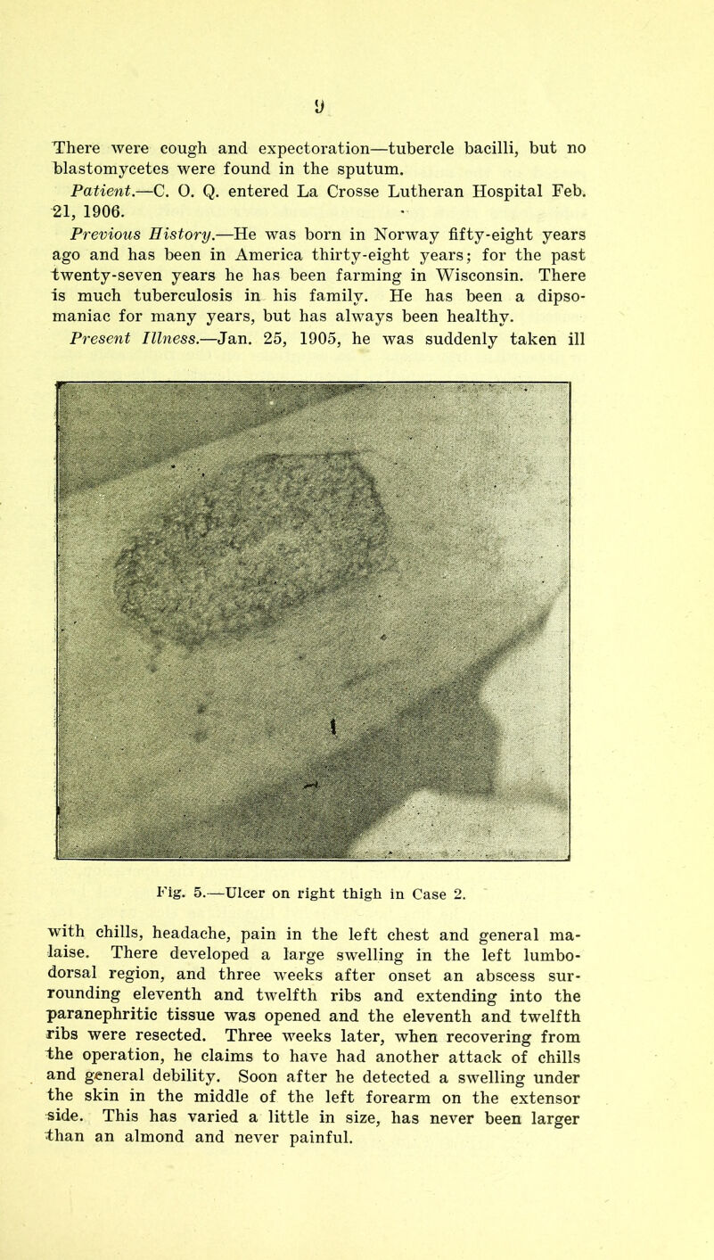 There were cough and expectoration—tubercle bacilli, but no blastomycetes were found in the sputum. Patient.—C. 0. Q. entered La Crosse Lutheran Hospital Feb. 21, 1906. Previous History.—He was born in Norway fifty-eight years ago and has been in America thirty-eight years; for the past twenty-seven years he has been farming in Wisconsin. There is much tuberculosis in his family. He has been a dipso- maniac for many years, but has always been healthy. Present Illness.—Jan. 25, 1905, he was suddenly taken ill Fig. 5.—Ulcer on right thigh in Case 2. with chills, headache, pain in the left chest and general ma- laise. There developed a large swelling in the left lumbo- dorsal region, and three weeks after onset an abscess sur- rounding eleventh and twelfth ribs and extending into the paranephritic tissue was opened and the eleventh and twelfth ribs were resected. Three weeks later, when recovering from the operation, he claims to have had another attack of chills and general debility. Soon after he detected a swelling under the skin in the middle of the left forearm on the extensor side. This has varied a little in size, has never been larger than an almond and never painful.