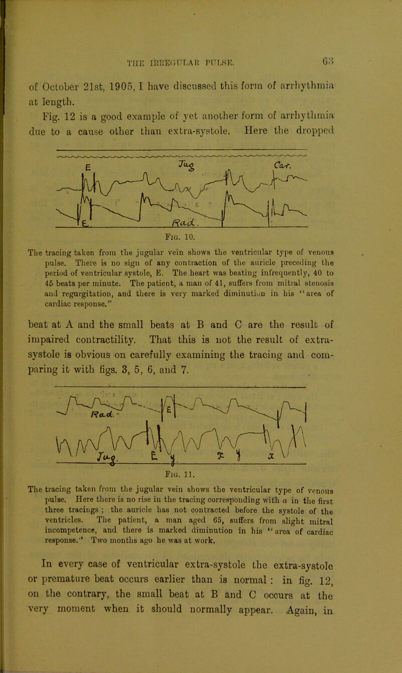ij’A of October 21st, 1905,1 have discussed this form of arrliytlimia at length. Fig. 12 is a good example of yet anoLlier form of arrhythmia due to a cause other than extra-systole. Here the dropped The tracing taken from the jugular vein shows the ventricular t}'pe of venous pulse. There is no sign of any contraction of the auricle preceding the period of ventricular systole, E. The heart w’as beating infrequently, 40 to 45 beats per minute. The patient, a man of 41, suffers from mitral stenosis and regurgitation, and there is very marked diminution in his “area of cardiac response.” beat at A and the small beats at B and C are the result of impaired contractility. That this is not the result of extra- systole is obvious on carefully examining the tracing and com- paring it with figs. 3, 5, 6, and 7. The tracing taken from the jugular vein shows the ventricular type of venous pulse. Here there is no rise in the tracing corre.sponding with a in the first three tracings ; the auricle has not contracted before the systole of the ventricles. The patient, a man aged 65, suffers from slight mitral incompetence, and there is marked diminution In his * ‘ area of cardiac response.’ Two months ago he was at work. In every case of ventricular extra-systole the extra-systole or premature beat occurs earlier than is normal : in fig. 12, on the contrary, the small beat at B and C occurs at the very moment when it should normally appear. Again, in