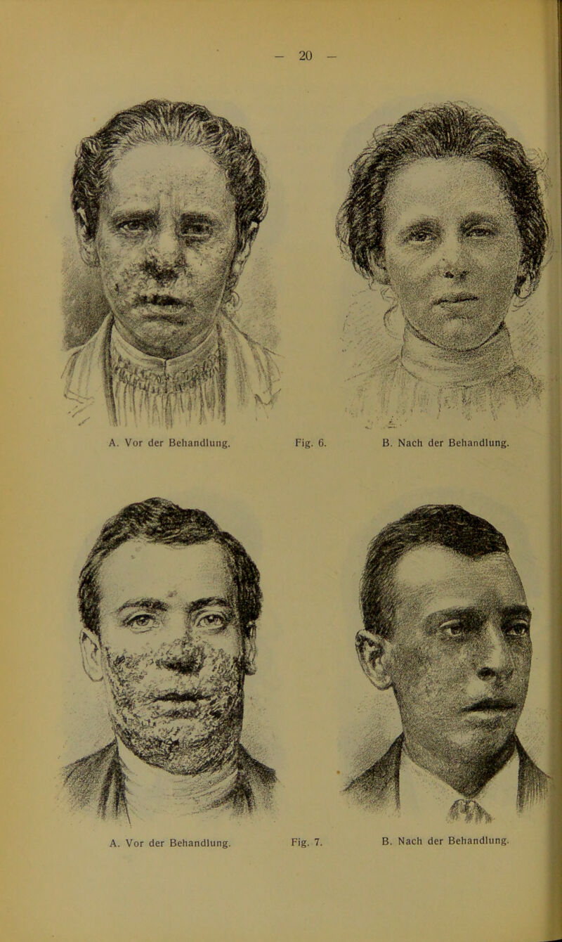 A. Vor der Behandlung. Fig. 6. B. Nach der Behandlung.