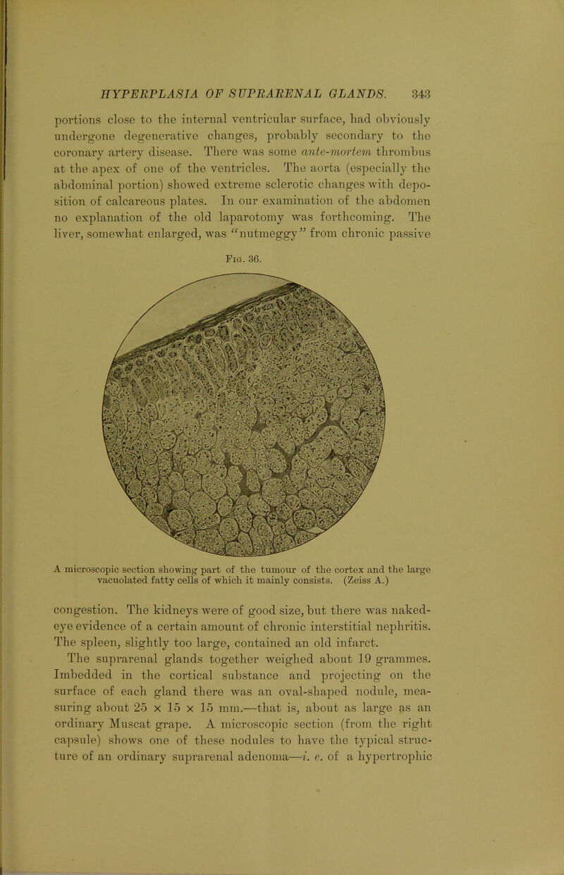 portions close to tlie internal ventricular surface^ had obviously undergone degenerative changes, probably secondary to the coronary artery disease. There was some ante-mortem thrombus at the apex of one of the ventricles. The aorta (especially the abdominal portion) showed extreme sclerotic changes with depo- sition of calcareous plates. In our examination of the abdomen no explanation of the old laparotomy was forthcoming. The liver, somewhat enlarged, was '^nutmeggy” from chronic passive Fig. 36. A microscopic section showing part of the tumour of the cortex and the large vacuolated fatty cells of which it mainly consists. (Zeiss A.) congestion. The kidneys were of good size, but there was naked- eye evidence of a certain amount of chronic interstitial nephritis. The .spleen, slightly too large, contained an old infarct. The suprarenal glands together weighed about 19 grammes. Imbedded in the cortical substance and projecting on the surface of each gland there was an oval-shaped nodule, mea- suring about 25 X 15 x 15 mm.—that is, about as large as an ordinary Muscat grape. A microscopic section (from the right capsule) shows one of these nodules to have the typical struc- ture of an ordinary suprarenal adenoma—i. e. of a hypertrophic