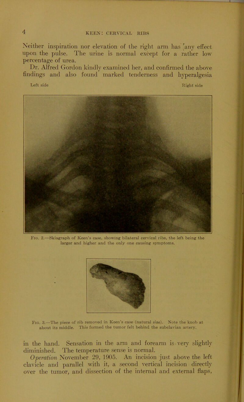 Neither inspiration nor elevation of the right arm has [^any effect upon the pulse. The urine is normal except for a rather low percentage of urea. Dr. Alfred Gordon kindly examined her, and confirmed the above findings and also found marked tenderness and hyperalgesia Left side Right side Fig. 2.—Skiagraph of Keen’s case, showing bilateral cervical ribs, the left being the larger and higher and the only one causing symptoms. Fig. 3.—The piece of rib removed in Keen’s case (natural size). Note the knob at about its middle. This formed the tumor felt behind the subclavian artery. in the hand. Sensation in the arm and forearm is-very slightly diminished. The temperature sense is normal. Operation November 29, 1905. An incision just above the left clavicle and parallel with it, a second vertical incision directly over the tumor, and dissection of the internal and external flaps.