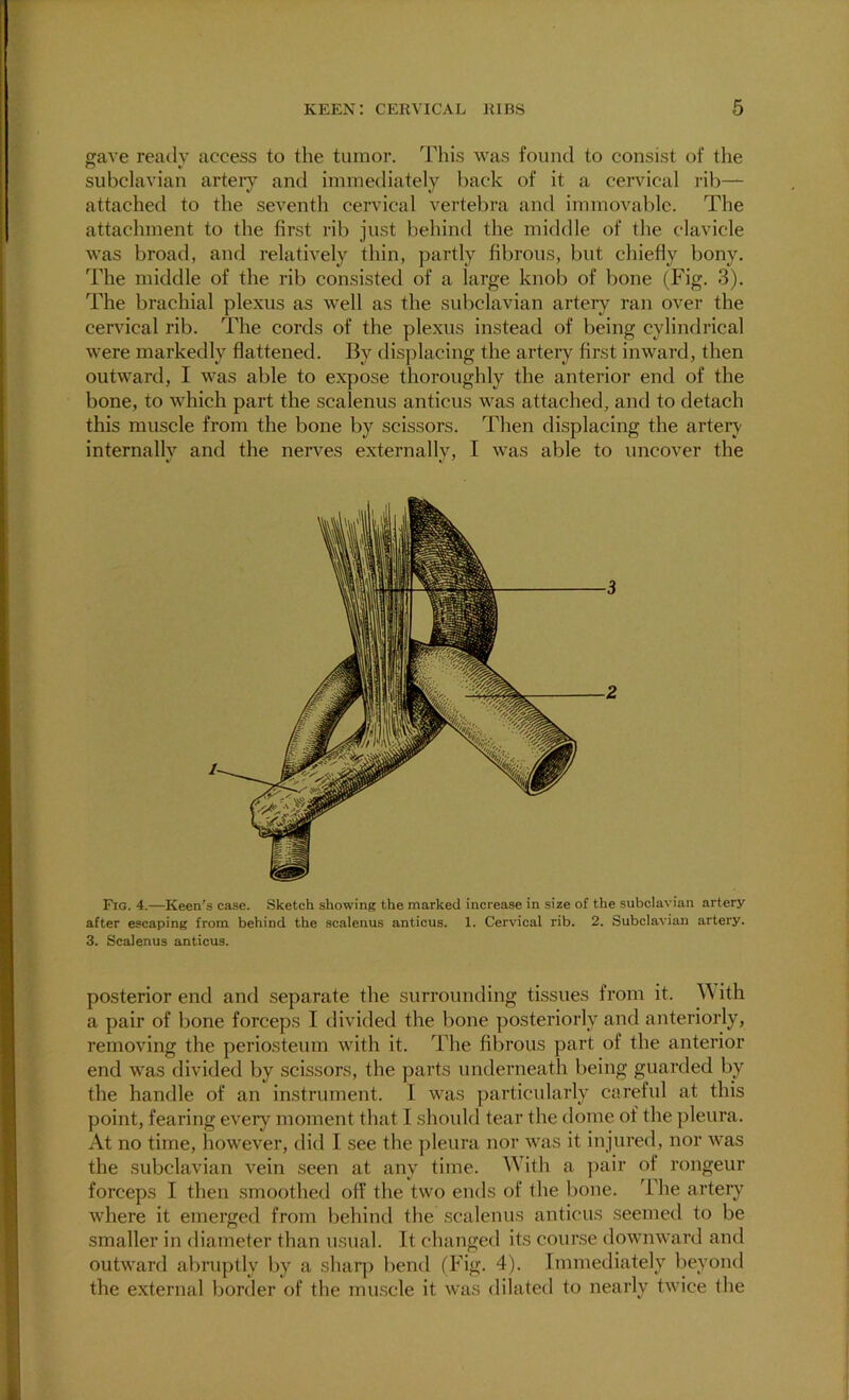 gave reatlv access to the tumor. This was found to consist of the subclavian artery and immediately back of it a cervical rib— attached to the seventh cervical vertebra and immovable. The attachment to the first rib just behind the middle of the clavicle was broad, and relatively thin, partly fibrous, but chiefly bony. The middle of the rib consisted of a large knob of bone (Pfig. 3). The brachial plexus as well as the subclavian artery ran over the cervical rib. The cords of the plexus instead of being cylindrical were markedly flattened. By displacing the artery first inward, then outward, I was able to expose thoroughly the anterior end of the bone, to which part the scalenus anticus was attached, and to detach this muscle from the bone by scissors. Then displacing the arterv internally and the nerves externally, I was able to uncover the Fio. 4.—Keen’s case. Sketch showing the marked increase in size of the subclavian artery after escaping from, behind the scalenus anticus. 1. Cervical rib. 2. Subclavian artery. 3. Scalenus anticus. posterior end and separate the surrounding tissues from it. ith a pair of bone forceps I divided the bone posteriorly and anteriorly, removing the periosteum with it. The fibrous part of the anterior end was divided by scissors, the parts underneath being guarded by the handle of an instrument. 1 was particularly careful at this point, fearing every moment that I should tear the dome of the pleura. At no time, however, did I see the pleura nor was it injured, nor was the subclavian vein .seen at any time. With a pair of rongeur forceps I then smoothed off the two emls of the lione. The artery where it emerged from behind the scalenus anticus seemed to be smaller in diameter than usual. It changed its course downward and outward abruptly by a shaqi bend (Pdg. 4). Immediately beyond the external liorder of the mu.scle it was dilated to nearly twice the