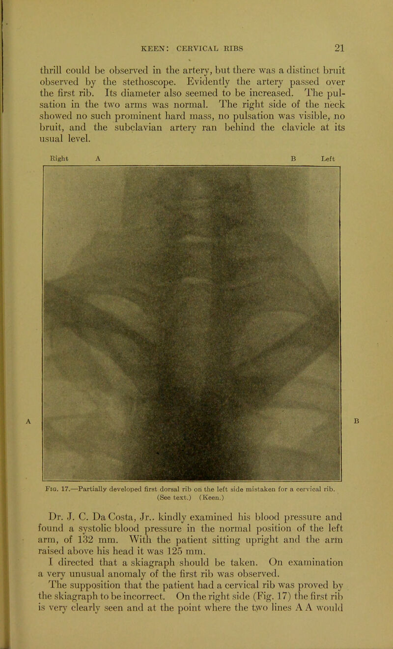 tlirill could be observed in the artery, but there was a distinct bruit observed by the stethoscope. Evidently the artery passed over the first rib. Its diameter also seemed to be increased. The pul- sation in the two arms was normal. The right side of the neck showed no such prominent hard mass, no pulsation was visible, no bruit, and the subclavian artery ran behind the clavicle at its usual level. Dr. J. C. Da Costa, Jr., kindly examined his blood pressure and found a systolic blood pressure in the normal position of the left arm, of 132 mm. With the patient sitting upright and the arm raised above his head it was 125 mm. I directed that a skiagraph should be taken. On examination a very unusual anomaly of the first rib was observed. The supposition that the patient had a cervical rib was proved by the skiagraph to be incorrect. On the right side (Fig. 17) the first rili is very clearly seen and at the point where the two lines A A would