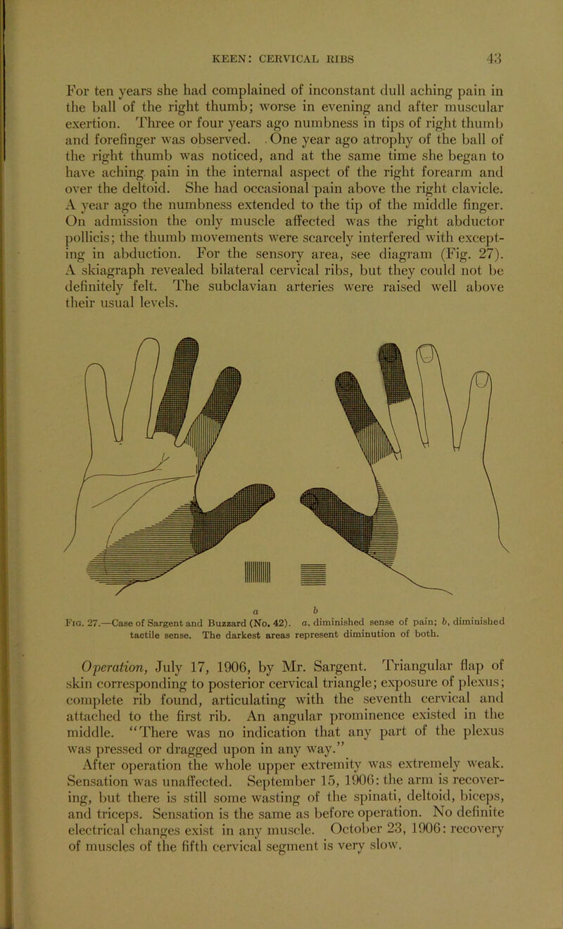 For ten years she had complained of inconstant dull aching pain in the ball of the right thumb; worse in evening and after muscular exertion. Three or four years ago numbness in tips of right thumb and forefinger was observed. . One year ago atrophy of the ball of the right thumb was noticed, and at the same time she began to have aching pain in the internal aspect of the right forearm and over the deltoid. She had occasional pain above the right clavicle. A year ago the numbness extended to the tip of the middle finger. On admission the only muscle affected was the right abductor pollicis; the thumb movements were scarcely interfered with except- ing in abduction. For the sensory area, see diagram (Fig. 27). A skiagraph revealed bilateral cervical ribs, but they could not be definitely felt. The subclavian arteries were raised well above their usual levels. a b Fig. 27.—Case of Sargent and Buzzard (No. 42). a, diminished sense of pain; 6, diminished tactile sense. The darkest areas represent diminution of both. Operation, July 17, 1906, by Mr. Sargent. Triangular flap of skin corresponding to posterior cervical triangle; exposure of plexus; complete rib found, articulating with the seventh cervical and attached to the first rib. An angular prominence existed in the middle. “There was no indication that any part of the plexus was pressed or dragged upon in any way.” After operation the whole upper extremity was extremely weak. Sensation was unaffected. September 15, 1906: the arm is recover- ing, but there is still some wasting of the spinati, deltoid, biceps, and triceps. Sensation is the same as before operation. No definite electrical changes exist in any muscle. October 23, 1906: recovery of muscles of the fifth cervical segment is very slow.