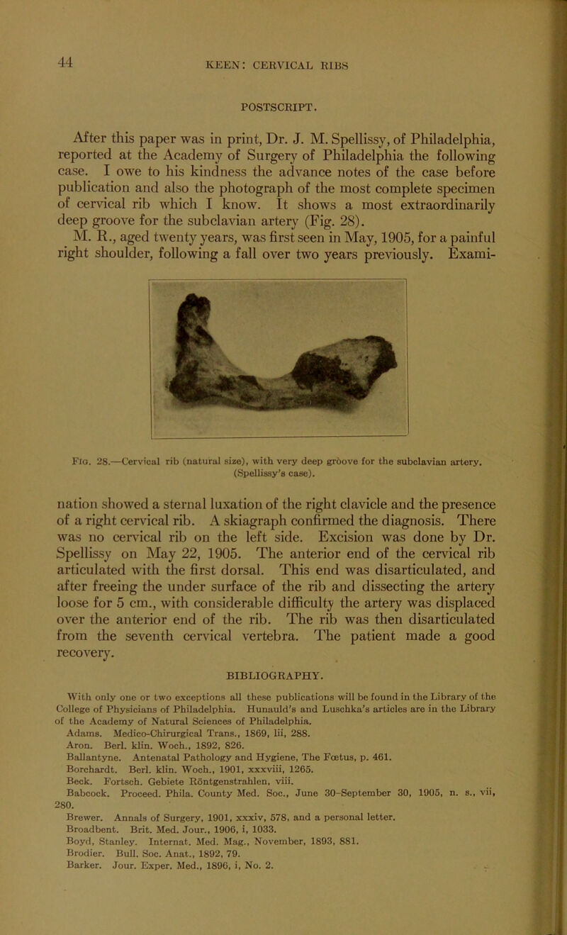 POSTSCRIPT. After this paper was in print, Dr. J. M. Spellissy, of Philadelphia, reported at the Academy of Surgery of Philadelphia the following case. I owe to his kindness the advance notes of the case before publication and also the photograph of the most complete specimen of cervical rib which I know. It shows a most extraordinarily deep groove for the subclavian artery (Fig. 28). M. R., aged twenty years, was first seen in May, 1905, for a painful right shoulder, following a fall over two years previously. Exami- Flo. 28.—Cervical rib (natiiral size), with very deep groove for the subclavian artery. (Spellissy’s case). nation showed a sternal luxation of the right clavicle and the presence of a right cervical rib. A skiagraph confirmed the diagnosis. There was no cervical rib on the left side. Excision was done by Dr. Spellissy on May 22, 1905. The anterior end of the cervical rib articulated with the first dorsal. This end was disarticulated, and after freeing the under surface of the rib and dissecting the artery loose for 5 cm., with considerable difficulty the artery was displaced over the anterior end of the rib. The rib was then disarticulated from the seventh cervical vertebra. The patient made a good recovery. BIBLIOGRAPHY. With only one or two exceptions all these publications will be found in the Library of the College of Physicians of Philadelphia. Hunauld's and Luschka’s articles are in the Library of the Academy of Natural Sciences of Philadelphia. Adams. Medico-Chirurgical Trans., 1869, lii, 288. Aron. Berl. klin. Woch., 1892, 826. Ballantyne. Antenatal Pathology and Hygiene, The Foetus, p. 461. Borchardt. Berl. klin. Woch., 1901, xxxviii, 1265. Beck. Fortsch. Gebiete Rontgenstrahlen, viii. Babcock. Proceed. Phila. County Med. Soc., June 30-September 30, 1905, n. s., vii, 280. Brewer. Annals of Surgery, 1901, xxxiv, 578, and a personal letter. Broadbent. Brit. Med. Jour., 1906, i, 1033. Boyd, Stanley. Internat. Med. Mag., November, 1893, 881. Brodier. Bull. Soc. Anat., 1892, 79. Barker. Jour. Exper. Med., 1896, i. No. 2. ^