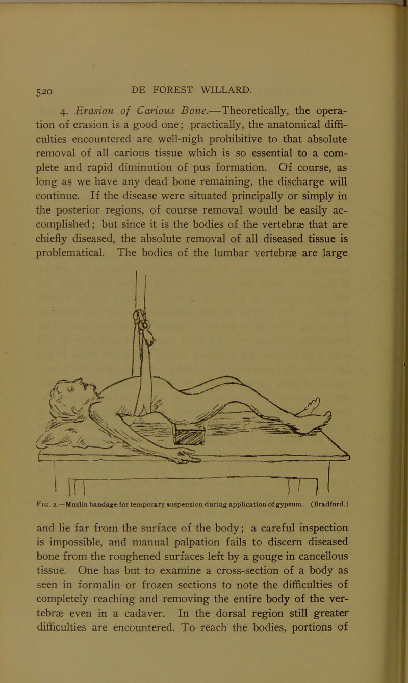 4. Erosion of Carious Bone.—Theoretically, the opera- tion of erasion is a good one; practically, the anatomical diffi- culties encountered are well-nigh prohibitive to that absolute removal of all carious tissue which is so essential to a com- plete and rapid diminution of pus formation. Of course, as long as we have any dead bone remaining, the discharge will continue. If the disease were situated principally or simply in the posterior regions, of course removal would be easily ac- complished ; but since it is the bodies of the vertebrae that are chiefly diseased, the absolute removal of all diseased tissue is problematical. The bodies of the lumbar vertebrae are large Fig. 2.—Muslin bandage for temporary suspension during application of gypsum. (Bradford.) and lie far from the surface of the body; a careful inspection is impossible, and manual palpation fails to discern diseased bone from the roughened surfaces left by a gouge in cancellous tissue. One has but to examine a cross-section of a body as seen in formalin or frozen sections to note the difficulties of completely reaching and removing the entire body of the ver- tebrae even in a cadaver. In the dorsal region still greater difficulties are encountered. To reach the bodies, portions of
