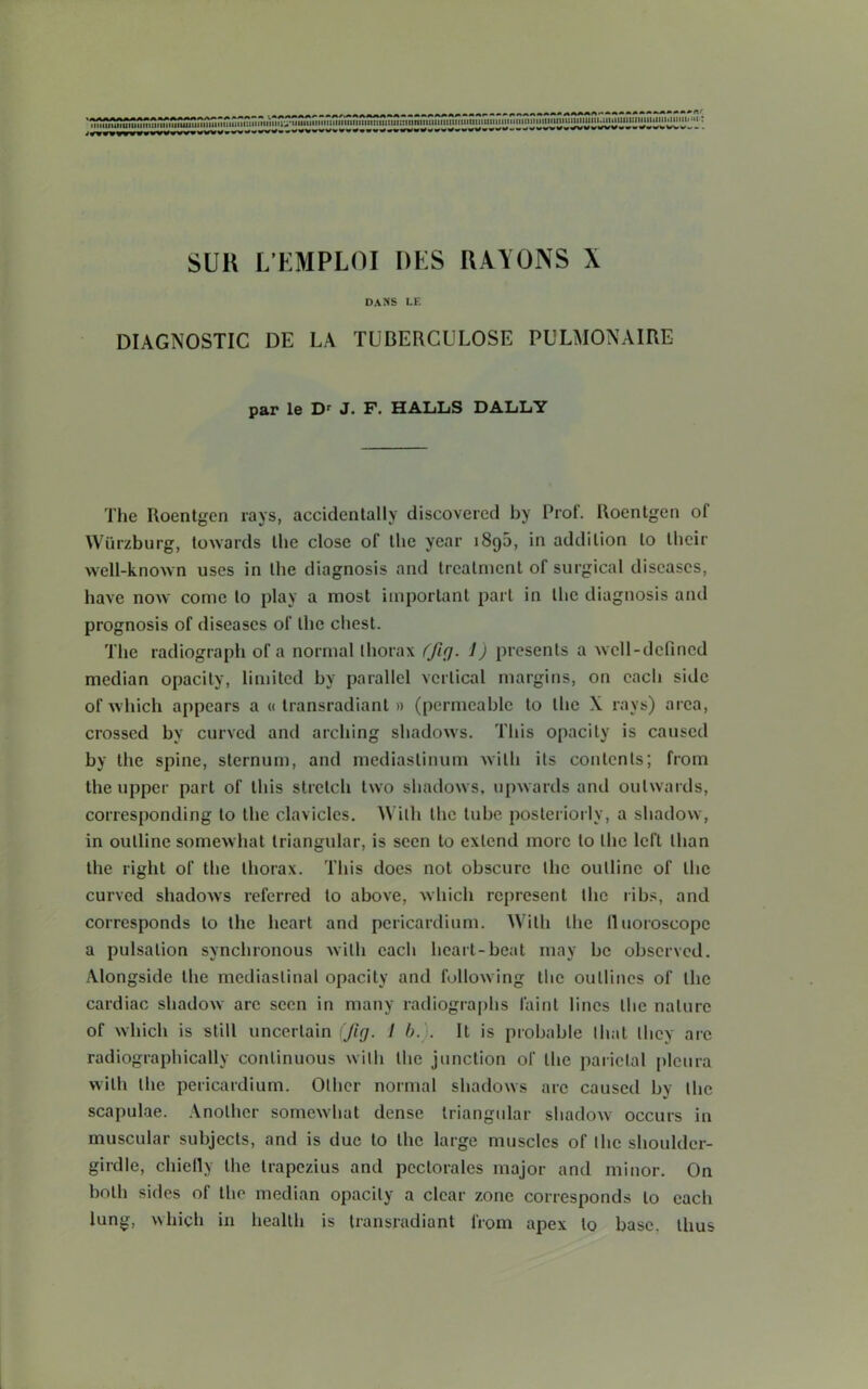 uimmiiuiiiiiiiuiiiimiiuiiiiiiiiuiiimu niunHinnu^uiuniTiTmnmnmmMuiimniinnmniiiiiiiiiitnntnnnitii i7mnmunnmiunuMi.iiiiiiiiii:nuutiniiiiiMii*u: • -ww*wW»rfVWW¥VW»»««#*W¥WVVw - . SUli L'KMPLOI DES UAVONS X dans le DIAGNOSTIC DE LA TUBERCULOSE PULMONAIRE par le Dr J. F. HALLS DALLY The Roentgen rays, accidentally discovered by Prof. Roentgen of Wurzburg, towards the close of the year 1890, in addition to their well-known uses in the diagnosis and treatment of surgical diseases, have now come to play a most important part in the diagnosis and prognosis of diseases of the chest. The radiograph of a normal thorax (fig. 1) presents a well-defined median opacity, limited by parallel vertical margins, on each side of which appears a « transradiant » (permeable to the X rays) area, crossed by curved and arching shadows. This opacity is caused by the spine, sternum, and mediastinum with its contents; from the upper part of this stretch two shadows, upwards and outwards, corresponding to the clavicles. Willi the tube posteriorly, a shadow, in outline somewhat triangular, is seen to extend more to the left than the right of the thorax. This does not obscure the outline of the curved shadows referred to above, which represent the libs, and corresponds to the heart and pericardium. With the IIHoroscope a pulsation synchronous with each heart-beat may be observed. Alongside the mediastinal opacity and following the outlines of the cardiac shadow arc seen in many radiographs faint lines the nature of which is still uncertain (fig. 1 b. . It is probable that they arc radiographically continuous with the junction of the parietal pleura with the pericardium. Other normal shadows are caused by the scapulae. Another somewhat dense triangular shadow occurs in muscular subjects, and is due to the large muscles of the shoulder- girdle, chiefly the trapezius and peclorales major and minor. On both sides of the median opacity a clear zone corresponds to each lung, which in health is transradiant from apex to base, thus