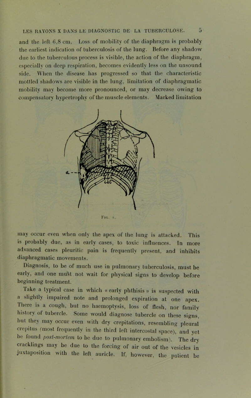 and the left (1,8 cm. Loss of mobility of the diaphragm is probably the earliest indication of tuberculosis of the lung. Before any shadow due to the tuberculous process is visible, the action of the diaphragm, especially on deep respiration, becomes evidently less on the unsound side. When the disease has progressed so that the characteristic mottled shadows are visible in the lung, limitation of diaphragmatic mobility may become more pronounced, or may decrease owing to compensatory hypertrophy of the muscle elements. Marked limitation Fio. may occur even when only the apex of the lung is attacked. Phis is probably due, as in early cases, to toxic influences. In more advanced cases pleuritic pain is frequently present, and inhibits diaphragmatic movements. Diagnosis, to be of much use in pulmonary tuberculosis, must be early, and one must not wait for physical signs to develop before beginning treatment. lake a typical case in which « early phthisis » is suspected with a slightly impaired note and prolonged expiration at one apex. There is a cough, but no haemoptysis, loss of flesh, nor family history ot tubercle. Some would diagnose tubercle on these signs, but may occur even with dry crepitations, resembling pleural crepitus (most frequently in the third left intercostal space), and yet be found post-mortem to be due to pulmonary embolism). The dry cracklings may be due to the forcing of air out of the vesicles in juxtaposition with the left auricle. If, however, the patient be