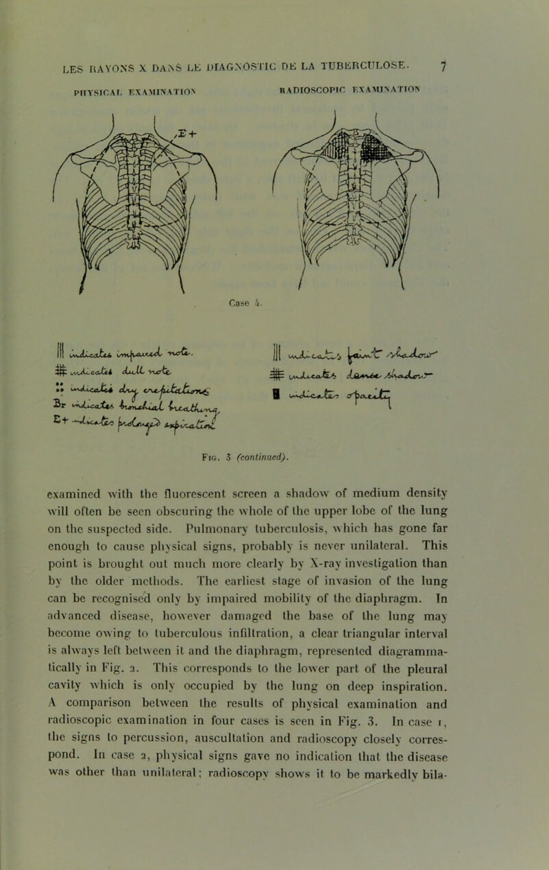 PHYSICAL EXAMINATION U A DIOSCOPIC EX A All N A TION 3$; cLuXL vurtt • * '*^J~CcJCz4 Br ^Xu^xXt^ iuni^Lud, kjUxJius^q E-E ^Lvc^O jrusOiy^} 4*^ jj[ If0-'-'' - 'vfcjLcjF' 4$^ uvXi-ia-iE^ isLtfUXs Ai\a^tn-T“ 8 i^<Cc<ufc) Fig. 3 (continued). examined with the fluorescent screen a shadoAV of medium density will often be seen obscuring the whole of the upper lobe of the lung on the suspected side. Pulmonary tuberculosis, which has gone far enough to cause physical signs, probably is never unilateral. This point is brought out much more clearly by X-ray investigation than by the older methods. The earliest stage of invasion of the lung can be recognised only by impaired mobility of the diaphragm. In advanced disease, hoxvever damaged the base of the lung may become OAving to tuberculous infiltration, a clear triangular interval is always left betAveen it and the diaphragm, represented diagramrna- tically in Fig. a. This corresponds to the loxver part of the pleural cavity xvhich is only occupied by the lung on deep inspiration. A comparison betAveen the results of physical examination and radioscopic examination in four cases is seen in Fig. 3. In case i, the signs to percussion, auscultation and radioscopy closely corres- pond. In case a, physical signs gave no indication that the disease was other than unilateral; radioscopy shoxvs it to be markedly bila-