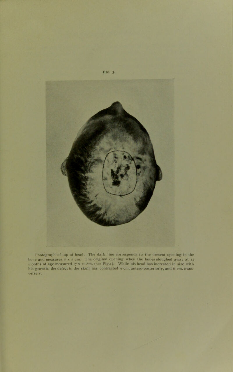 Photograph of top of hear). The dark line corresponds to the present opening in the hone and measures 8x5 cm. The original opening when the bones sloughed away at 13 months of age measured 17 x 11 cm. (see Fig.i). While his head has increased in size with his growth, the defect in the skull has contracted 9 cm. antero-posteriorly, and 6 cm. trans- versely.