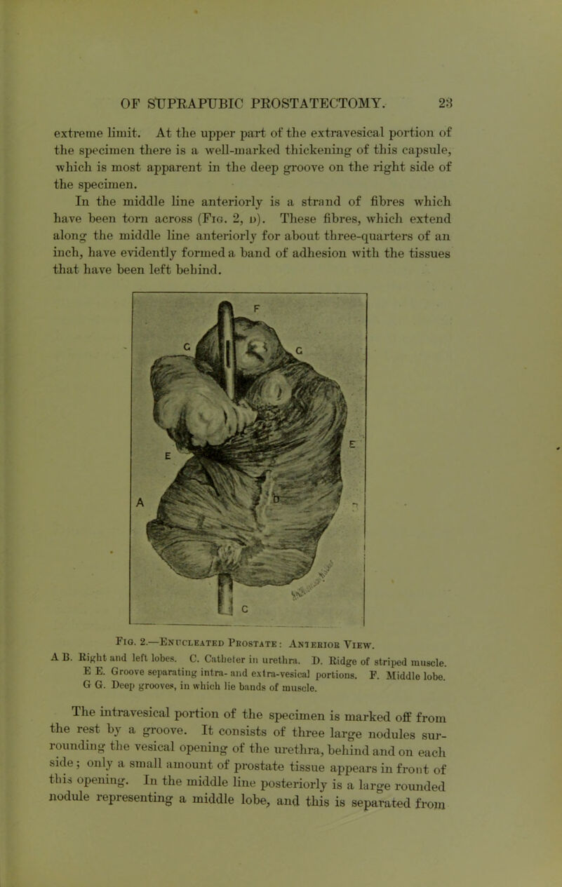 extreme limit. At the upper part of the extravesical portion of the specimen there is a well-marked thickening of this capsule, which is most apparent in the deep groove on the right side of the specimen. In the middle line anteriorly is a strand of fibres which have been torn across (Fig. 2, n). These fibres, which extend along the middle line anteriorly for about three-quarters of an inch, have evidently formed a band of adhesion with the tissues that have been left behind. Fig. 2.—Enucleated Prostate: Anterior View. A B. Eight and left lobes. C. Catheter in urethra. D. Ridge of striped muscle. E E. Groove separating intra- and extra-vesical portions. F. Middle lobe. G G. Deep grooves, in which lie bands of muscle. The intravesical portion of the specimen is marked off from the rest by a groove. It consists of three large nodules sur- rounding the vesical opening of the urethra, behind and on each side ; only a small amount of prostate tissue appears in front of this opening. In the middle line posteriorly is a large rounded nodule representing a middle lobe, and this is separated from