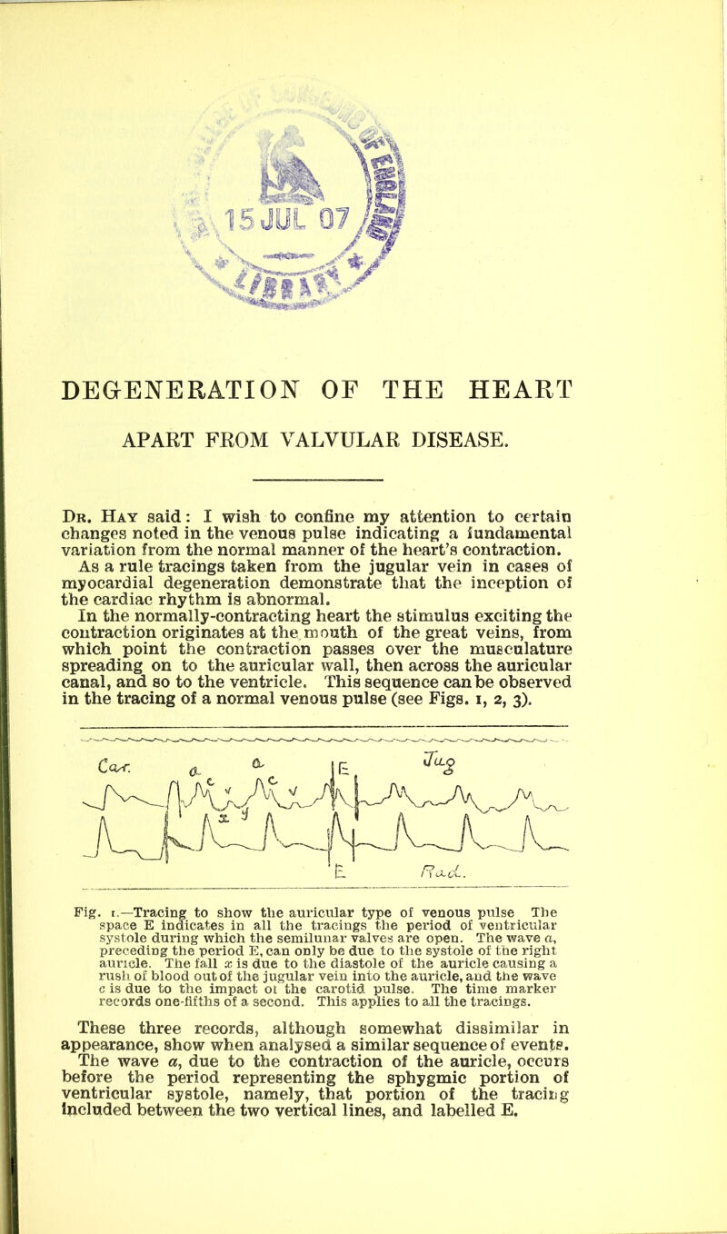 DEGENERATION OF THE HEART APART FROM VALVULAR DISEASE. Dr. Hay said: I wish to confine my attention to certain changes noted in the venous pulse indicating a fundamental variation from the normal manner of the heart’s contraction. As a rule tracings taken from the jugular vein in cases of myocardial degeneration demonstrate that the inception of the cardiac rhythm is abnormal. In the normally-contracting heart the stimulus exciting the contraction originates at the mouth of the great veins, from which point the contraction passes over the musculature spreading on to the auricular wall, then across the auricular canal, and so to the ventricle. This sequence can be observed in the tracing of a normal venous pulse (see Figs, i, 2, 3). Fig. t.—Tracing to show the auricular type of venous pulse The space E indicates in all the tracings the period of ventricular systole during which the semilunar valves are open. The wave a, preceding the period E, can only be due to the systole of the right auricle. The fall x is due to the diastole of the auricle causing a rush of blood out of the jugular vein into the auricle, and the wave c is due to the impact ot the carotid pulse. The time marker records one-fifths of a second. This applies to all the tracings. These three records, although somewhat dissimilar in appearance, show when analysed a similar sequence of events. The wave a, due to the contraction of the auricle, occurs before the period representing the sphygmic portion of ventricular systole, namely, that portion of the tracing included between the two vertical lines, and labelled E.