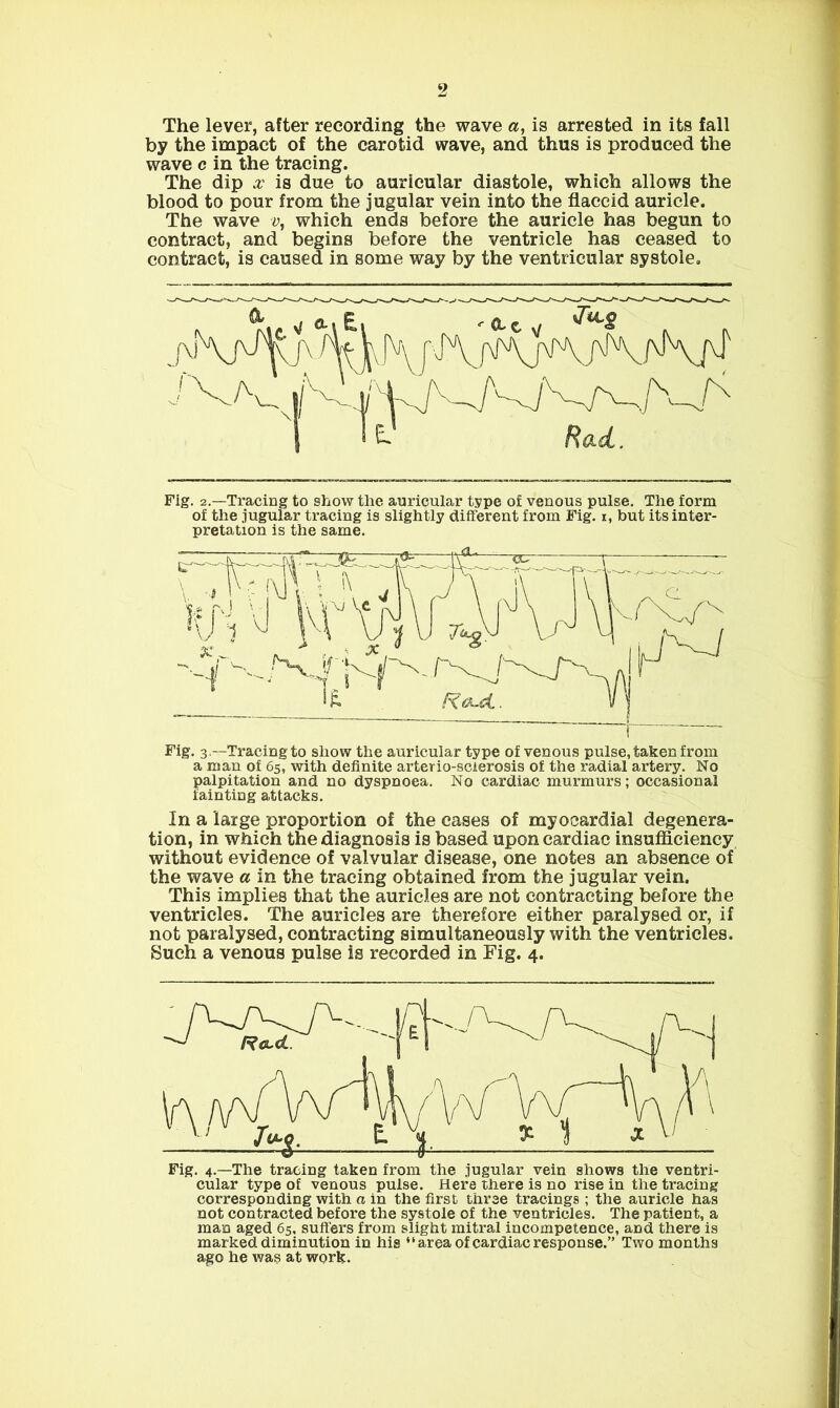 The lever, after recording the wave a, is arrested in its fall by the impact of the carotid wave, and thus is produced the wave c in the tracing. The dip x is due to auricular diastole, which allows the blood to pour from the jugular vein into the flaccid auricle. The wave y, which ends before the auricle has begun to contract, and begins before the ventricle has ceased to contract, is caused in some way by the ventricular systole. Fig. 2.—Tracing to show the auricular type of venous pulse. The form of the jugular tracing is slightly different from Fig. i, but its inter- pretation is the same. Fig. 3.—Tracing to show the auricular type of venous pulse, taken from a man of 65, with definite arterio-scierosis of the radial artery. No palpitation and no dyspnoea. No cardiac murmurs; occasional fainting attacks. In a large proportion of the cases of myocardial degenera- tion, in which the diagnosis is based upon cardiac insufficiency without evidence of valvular disease, one notes an absence of the wave a in the tracing obtained from the jugular vein. This implies that the auricles are not contracting before the ventricles. The auricles are therefore either paralysed or, if not paralysed, contracting simultaneously with the ventricles. Such a venous pulse is recorded in Fig. 4. Fig. 4.—The tracing taken from the jugular vein shows the ventri- cular type of venous pulse. Here there is no rise in the tracing corresponding with a in the first three tracings ; the auricle has not contracted before the systole of the ventricles. The patient, a man aged 65, suffers from slight mitral incompetence, and there is marked diminution in his “area of cardiac response.” Two months ago he was at work.