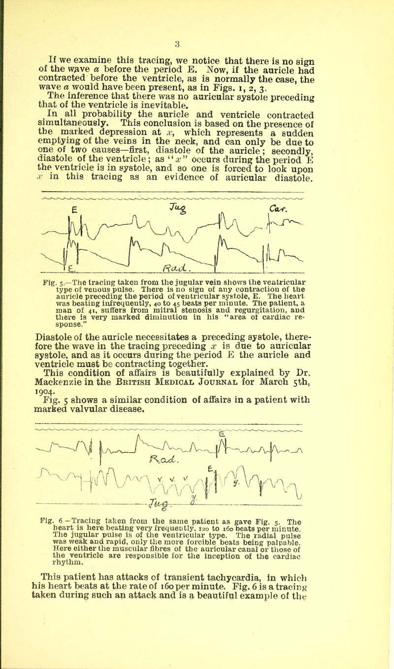 If we examine this tracing, we notice that there is no sign of the wave a before the period E. Now, if the auricle had contracted before the ventricle, as is normally the case, the wave a would have been present, as in Figs, i, 2, 3. The inference that there was no auricular systole preceding that of the ventricle is inevitable. In all probability the auricle and ventricle contracted simultaneously. This conclusion is based on the presence of the marked depression at .r, which represents a sudden emptying of the veins in the neck, and can only be due to one of two causes—first, diastole of the auricle; secondly, diastole of the ventricle; as “a.’” occurs during the period E the ventricle is in systole, and so one is forced to look upon X in this tracing as an evidence of auricular diastole. Fig. 5.—The tracing taken from the jugular vein shows the ventricular type of venous pulse. There is no sign of any contraction of the auricle preceding the period of ventricular systole, E. The heart was beating infrequently, 40 to 45 beats per minute. The patient, a man of 41, suffers from mitral stenosis and regurgitation, and there is very marked diminution in his “area of cardiac re- sponse.” Diastole of the auricle necessitates a preceding systole, there- fore the wave in the tracing preceding x is due to auricular systole, and as it occurs during the period E the auricle and ventricle must be contracting together. This condition of affairs is beautifully explained by Di\ Mackenzie in the British Medical Journal for March 5th, 1904. Fig. 5 shows a similar condition of affairs in a patient with marked valvular disease. Fig. 6- Tracing taken from the same patient as gave Fig. 5. The heart is here beating very frequently, 120 to 160 beats per minute. The jugular pulse is of the ventricular type. The radial pulse was weak and rapid, only the more forcible beats being palpable. Here either the muscular fibres of the auricular canal or those of the ventricle are responsible for the inception of the cardiac rhythm. This patient has attacks of transient tachycardia, in which his heart beats at the rate of 160 per minute. Fig. 6 is a tracing taken during such an attack and is a beautiful example of the