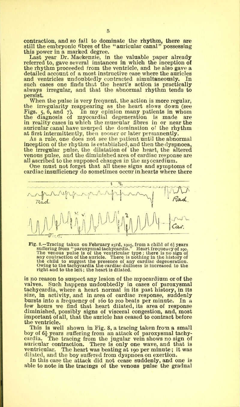 contraction, and so fail to dominate the rhythm, there are still the embryonic fibres of the “auricular canal” possessing this power in a marked degree. Last year Dr. Mackenzie, in the valuable paper already referred to, gave several instances in which the inception of the rhythm proceeded from the ventricle, and he also gave a detailed account of a most instructive case where the auricles and ventricles undoubtedly contracted simultaneously. In such cases one finds that the heart’s action is practically always irregular, and that the abnormal rhythm tends to persist. When the pulse is very frequent, the action is more regular, the irregularity reappearing as the heart slows down (see Figs. 5, 6, and 7). In my opinion many patients in whom the diagnosis of myocardial degeneration is made are in reality cases in which the muscular fibres in or near the auricular canal have usurped the domination o? the rhythm at first intermittently, thee sooner or later permanently. As a rule, one does not see the patient until the abnormal inception of the rhythm is established, and then the dyspnoea, the irregular pulse, the dilatation of the heart, the altered venous pulse, and the diminished area of cardiac response are all ascribed to the supposed changes in the myocardium. One must not forget that all these signs and symptoms of cardiac insufficiency do sometimes occur in hearts where there Fig. 8.~Tracing taken on February 23rd, 1905, from a child of 6f years suffering from “ paroxysmal tachycardia.” Heart frequency of 190. The venous pulse is of the ventricular type ; there is no sign of any contraction of the auricle. There is nothing in the history of the child to suggest the presence of any cardiac degeneration. Owing to the tachycardia the cardiac dullness is increased to the right and to the left; the heart is dilated. is no reason to suspect any lesion of the myocardium or of the valves. Such happens undoubtedly in cases of paroxysmal tachycardia, where a heart normal in its past history, in its size, in activity, and in area of cardiac response, suddenly bursts into a frequency of 160 to 200 beats per minute. In a few hours we find that heart dilated, its area of response diminished, possibly signs of visceral congestion, and, most important of all, that the auricle has ceased to contract before the ventricle. This is well shown in Fig, 8, a tracing taken from a small boy of years suffering from an attack of paroxysmal tachy- cardia. The tracing from the jugular vein shows no sign of auricular contraction. There is only one wave, and that is ventricular. The heart was beating at 190 per minute; it was dilated, and the boy suffered from dyspnoea on exertion. In this case the attack did not cease suddenly, and one is able to note in the tracings of the venous pulse the gradual