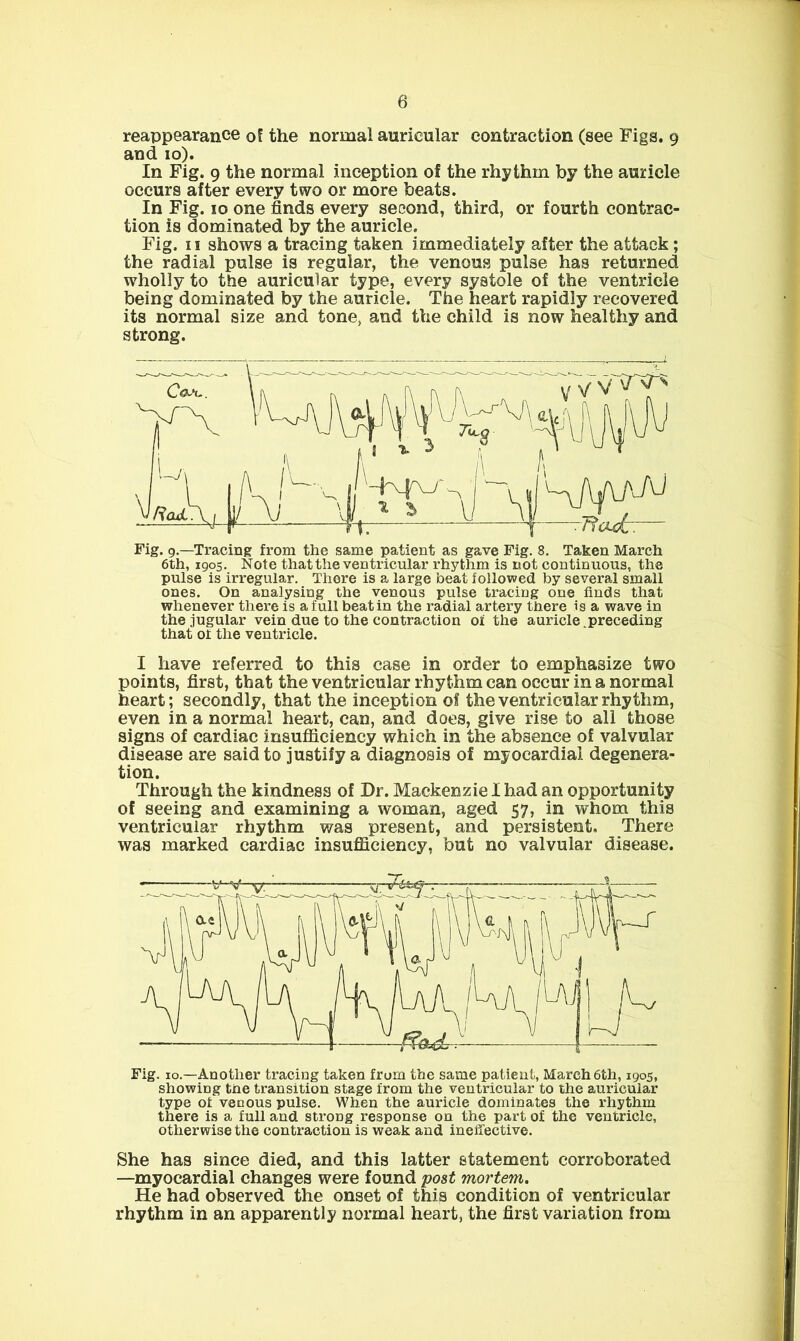 reappearance of the normal auricular contraction (see Figs. 9 and 10). In Fig. 9 the normal inception of the rhythm by the auricle occurs after every two or more beats. In Fig. 10 one finds every second, third, or fourth contrac- tion is dominated by the auricle. Fig. II shows a tracing taken immediately after the attack; the radial pulse is regular, the venous pulse has returned wholly to the auricular type, every systole of the ventricle being dominated by the auricle. The heart rapidly recovered its normal size and tone, and the child is now healthy and strong. Fig. 9.—Tracing from the same patient as gave Fig. 8. Taken March 6th, 1905. Note that the ventricular rhythm is not continuous, the pulse is irregular. There is a large beat followed by several small ones. On analysing the venous pulse tracing one finds that whenever there is a full beat in the radial artery there is a wave in the jugular vein due to the contraction of the auricle.preceding that of the ventricle. I have referred to this case in order to emphasize two points, first, that the ventricular rhythm can occur in a normal heart; secondly, that the inception of the ventricular rhythm, even in a normal heart, can, and does, give rise to all those signs of cardiac insufficiency which in the absence of valvular disease are said to justify a diagnosis of myocardial degenera- tion. Through the kindness of Dr. Mackenzie I had an opportunity of seeing and examining a woman, aged 57, in whom this ventricular rhythm was present, and persistent. There was marked cardiac insufficiency, but no valvular disease. Fig. 10.—Another tracing taken from the same patient, March 6th, 1905, showing the transition stage from the ventricular to the auricular type ot venous pulse. When the auricle dominates the rhythm there is a full and strong response on the part of the ventricle, otherwise the contraction is weak and ineffective. She has since died, and this latter statement corroborated —myocardial changes were found post mortem. He had observed the onset of this condition of ventricular rhythm in an apparently normal heart, the first variation from
