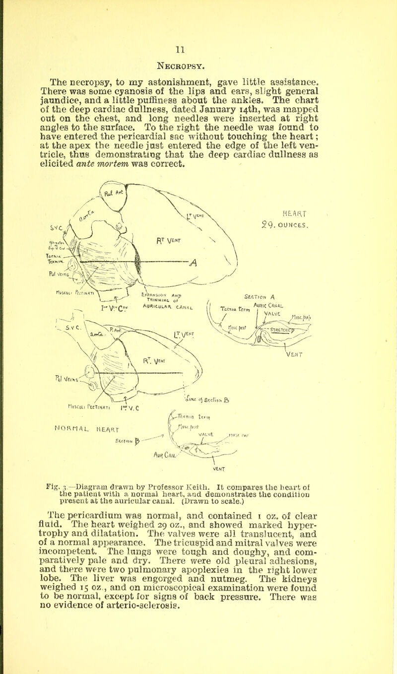 Necropsy. The necropsy, to my astonishment, gave little assistenee. There was some cyanosis of the lips and ears, slight general Jaundice, and a little puffineas about the ankles. The chart of the deep cardiac dullness, dated January 14th, was mapped out on the chest, and long needles were inserted at right angles to the surface. To the right the needle was found to have entered the pericardial sac without touching the heart; at the apex the needle Just entered the edge of the left ven- tricle, thus demonstrating that the deep cardiac dullness as elicited ante mortem was correct. Fig. 3 —Diagram drawn by Professor Keith. It compares the heart of the patient with a normal heart, and demonstrates the condition present at the auricular canal. (Drawn to scale.) The pericardium was normal, and contained i oz. of clear fluid. The heart weighed 29 oz., and showed marked hyper- trophy and dilatation. The valves were all translucent, and of a normal appearance. The tricuspid and mitral valves were incompetent. The lungs were tough and doughy, and com- paratively pale and dry. There were old pleural adhesions, and there were two pulmonary apoplexies in the right lower lobe. The liver was engorged and nutmeg. The kidneys weighed 15 oz., and on microscopical examination were found to be normal, except for signs of back pressure. There was no evidence of arterio-sclerosis.