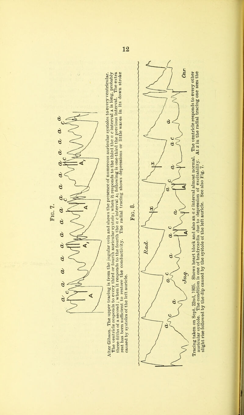 auricular systole. The condition is one of bradycardia due to depression of excitability. At x in the radial tracing one sees the slight rise followed by the dip caused by the systole of the left auricle. See also Fig. 7.
