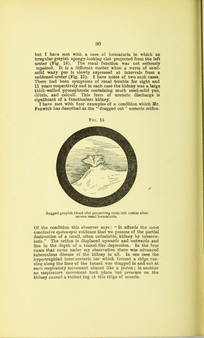 but I have met with a case of hsematuria in which an irregular greyish spongy-looking clot projected from the left ureter (Fig. 14). The renal function was not seriously mpaired. It is a different matter when a worm of semi- solid waxy pus is slowly expressed at intervals from a reddened ureter (Fig. 15). I have notes of two such cases. There had been symptoms of renal trouble for eight and 11 years respectively and in each case the kidney was a large thick-walled pyonephrosis containing much semi-solid pus, debris, and calculi. This form of ureteric discharge is significant of a functionless kidney. I have met with four examples of a condition which Mr. Fenwick has described as the “dragged out ” ureteric orifice. Ragged greyish blood clot projecting from left ureter after severe renal haematuria. Of the condition this observer says: “It affords the most conclusive cystoscopic evidence that we possess of the partial destruction of a small, often unfeelable, kidney by tubercu- losis.” The orifice is displaced upwards and outwards and lies in the depth of a tunnel-like depression. In the four cases that came under my observation there was advanced tuberculous disease of the kidney in all. In one case the hypertrophied inter-ureteric bar which formed a ridge run- ning along the floor of the tunnel was dragged in and out at each respiratory movement almost like a piston; in another no respiratory movement took place but pressure on the kidney caused a violent tug at this ridge of muscle. Fig. 14.