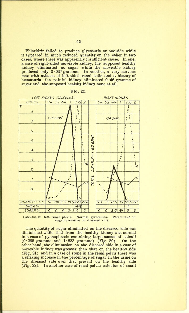 48 Phloridzin failed to produce glycosuria on one side while it appeared in much reduced quantity on the other in two cases, where there was apparently insufficient cause. In one, a case of right-sided moveable kidney, the supposed healthy kidney eliminated no sugar while the moveable kidney produced only 0 • 037 gramme. In another, a very nervous man with attacks of left-sided renal colic and a history of haematuria, the painful kidney eliminated 0*46 gramme of sugar and the supposed healthy kidney none at all. Fig. 22. Calculus in left renal pelvis. Normal glvco&uria. Percentage of sugar excessive on diseased side. The quantity of sugar eliminated on the diseased side was diminished while that from the healthy kidney was normal in a case of pyonephrosis containing large masses of calculi (0*395 gramme and 1*623 gramme) (Fig. 20). On the other hand, the elimination on the diseased side in a case of moveable kidney was greater than that on the healthy side (Fig. 21), and in a case of stone in the renal pelvis there was a striking increase in the percentage of sugar in the urine on the diseased side over that present on the healthy side (Fig. 22). In another case of renal pelvic calculus of small