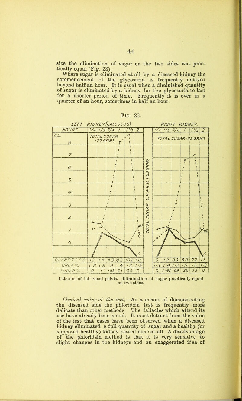 size the elimination of sugar on the two sides was prac- tically equal (Fig. 23). Where sugar is eliminated at all by a diseased kidney the commencement of the glycosuria is frequently delayed beyond half an hour. It is usual when a diminished quantity of sugar is eliminated by a kidney for the glycosuria to last for a shorter period of time. Frequently it is over in a quarter of an hour, sometimes in half an hour. Fig. 23. Calculus of left renal pelvis. Elimination of sugar practically equal on two sides. Clinical valve of the test.—As a means of demonstrating the diseased side the phloridzin test is frequently more delicate than other methods. The fallacies which attend its use have already been noted. It must detract from the value of the test that cases have been observed when a diseased kidney eliminated a full quantity of sugar and a healthy (or supposed healthy) kidney passed none at all. A disadvantage of the phloridzin method is that it is very sensitive to slight changes in the kidneys and an exaggerated idea of
